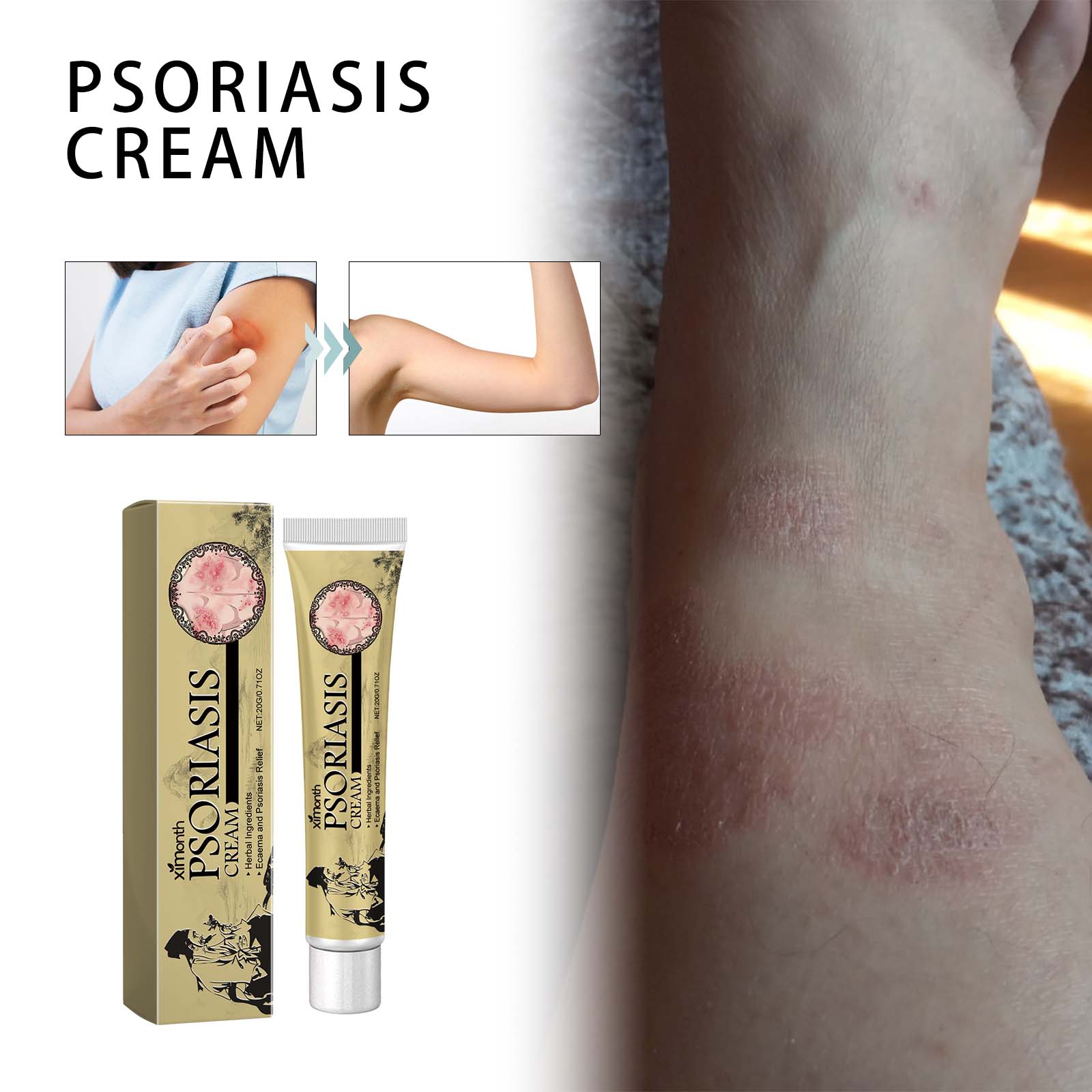 Breaking Itch King Psoriasis Cream, Fast Relief for Red, Itchy, and Irritated Skin ,20g