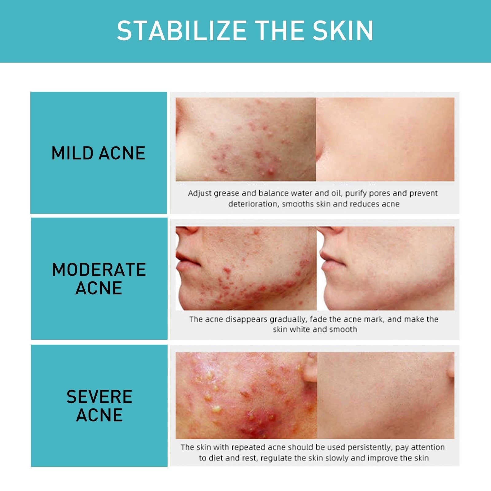 Clear Acne Marks Fast, Hydrating Repair Gel for Bright, Smooth Skin ,20g