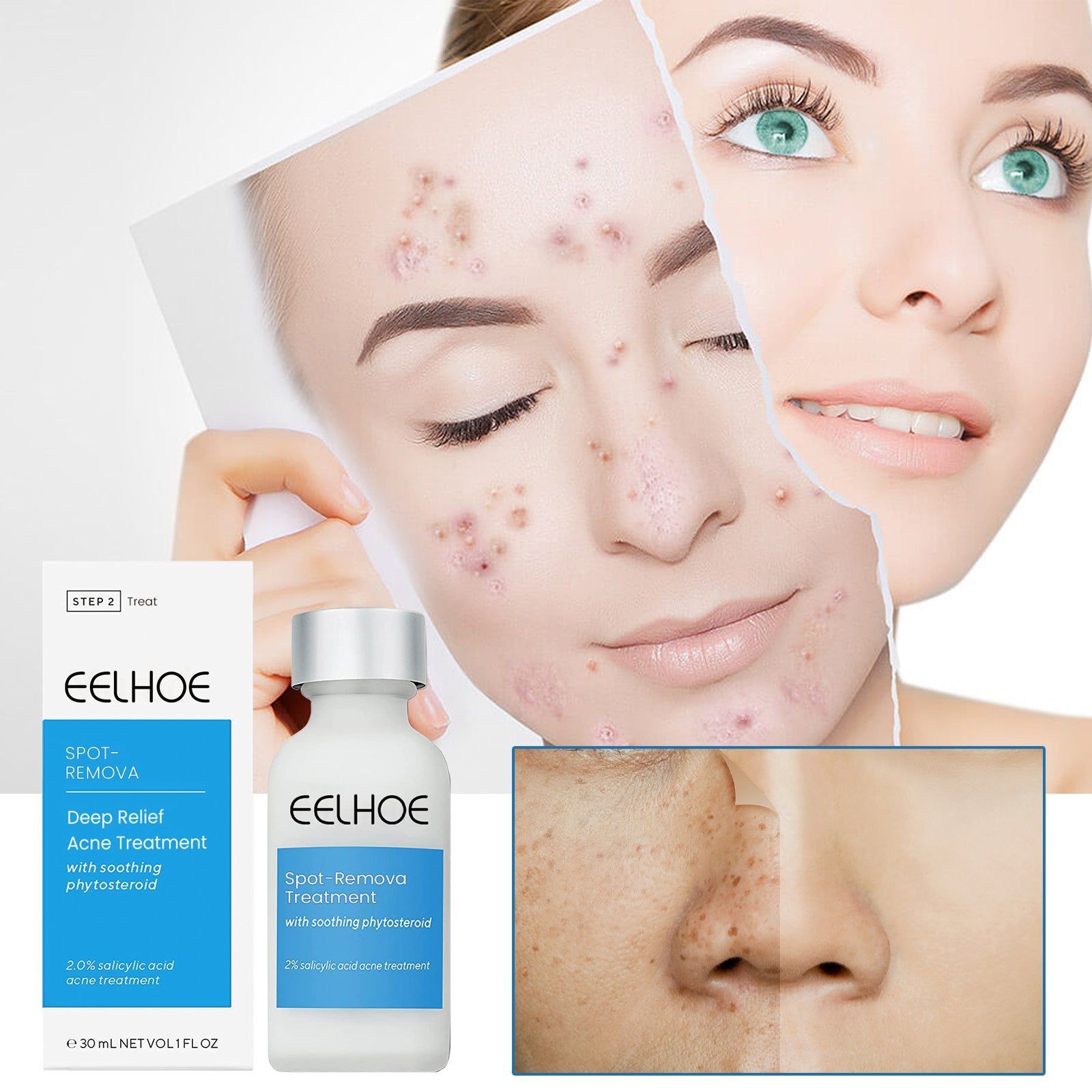 Blemish Smoothing Emulsion, Acne Spot Removal, Clear Skin, Pimple Treatment ,30g