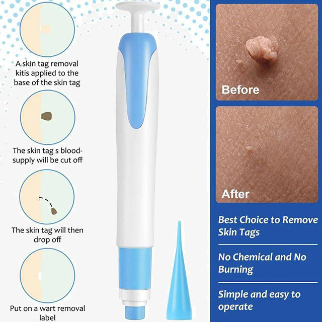 Auto Skin Tags Removal Tool Device with Cleansing Wipes - Safe, Painless Skin Tag Remover Kit