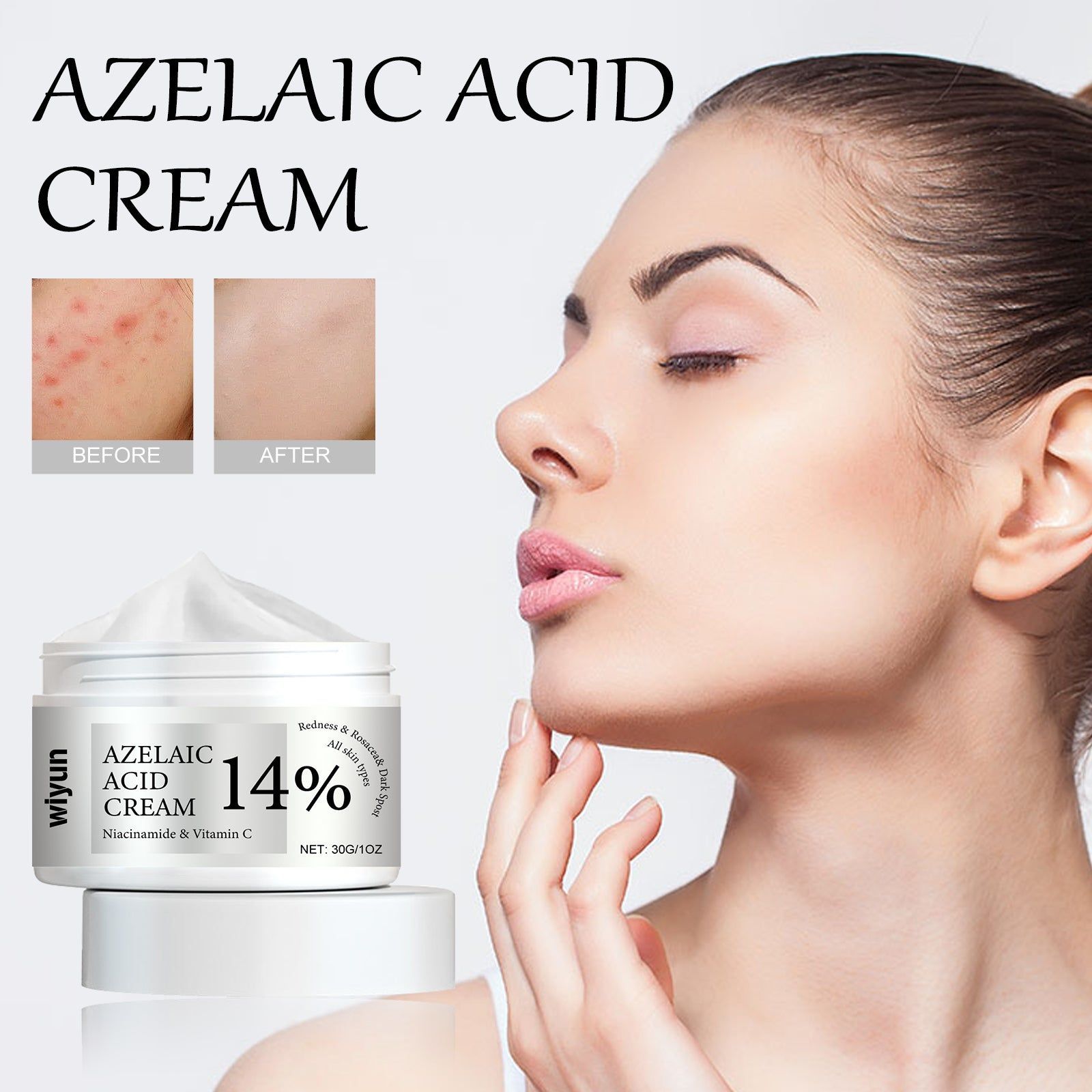 Azelaic Acid Cream, Lightens Breakouts, Clears Acne, Brightens Skin, Pore Refining ,30g