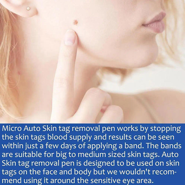 Auto Skin Tags Removal Tool Device with Cleansing Wipes - Safe, Painless Skin Tag Remover Kit