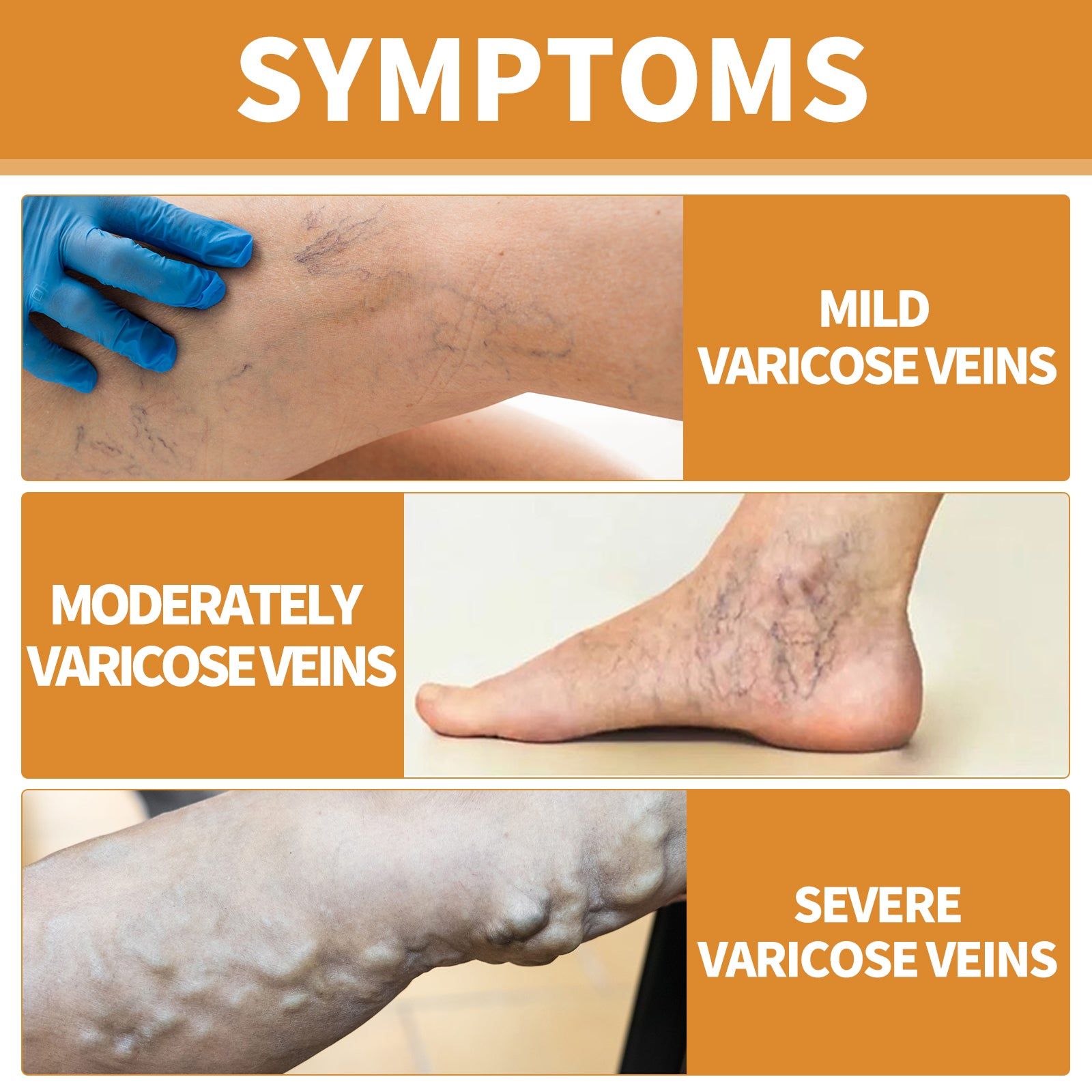 Vein Treatment Cream Relieves Soreness Swelling Moisturizes Legs ,30g