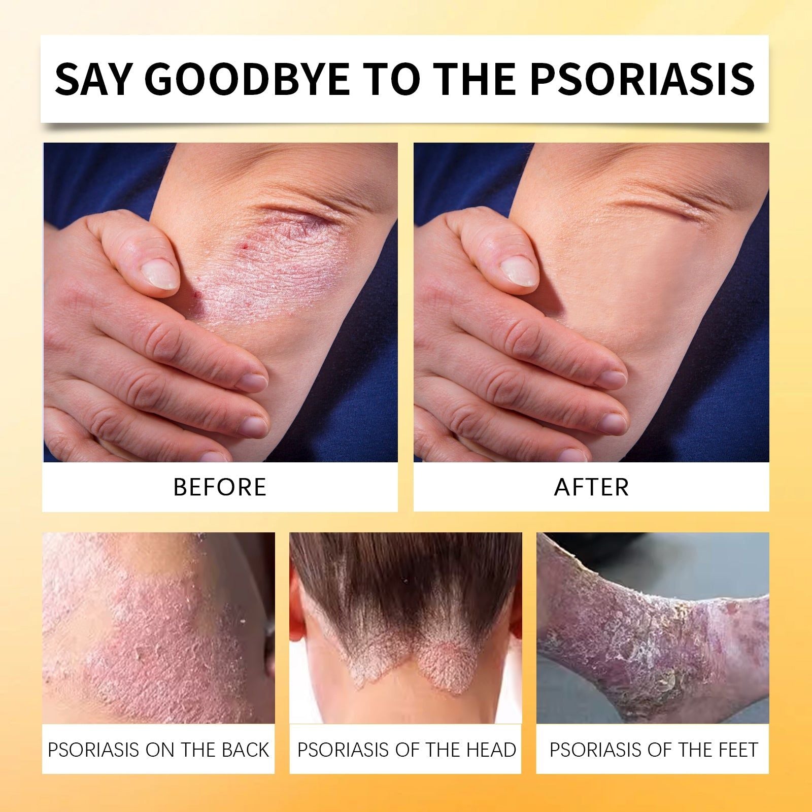 Bee Venom Psoriasis Care Spray, Anti-Itch, Skin Relief, Natural Healing, Fast Results ,20ml