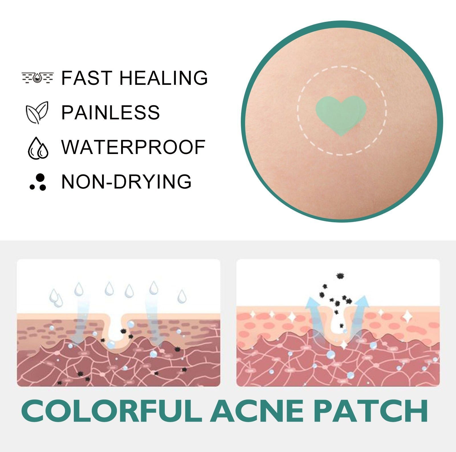 Colorful Acne Patch, Clear Acne Removal, Fast Spot & Mark Healing ,144pieces