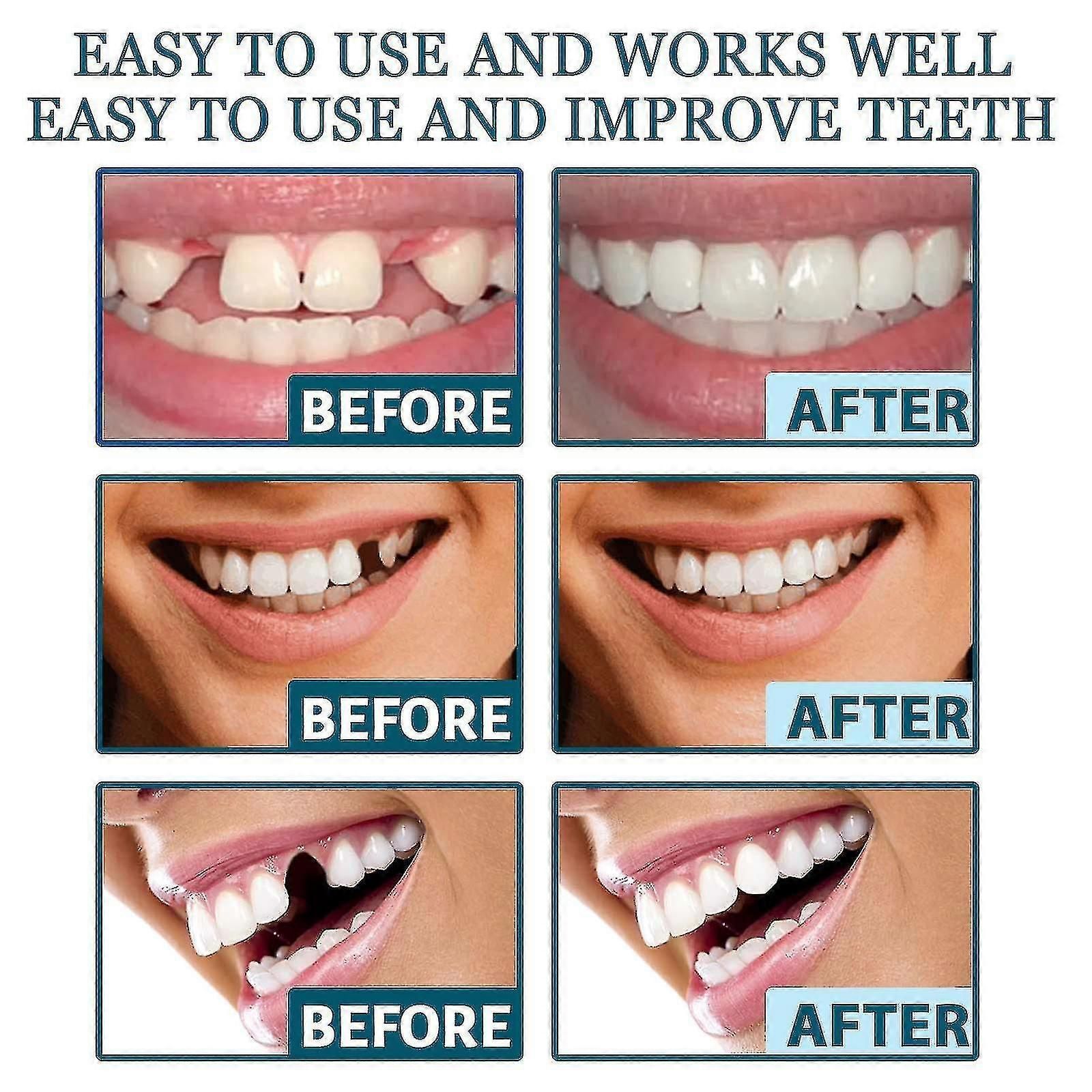 Denture Teeth Temporary Fake Teeth For Snap On Instant Confidence Smile, Dental Veneers For Temporary Teeth Restoration zxin