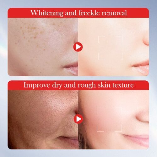 Freckle & Dark Spot Removing Cream with Kojic Acid - 001- SD10407