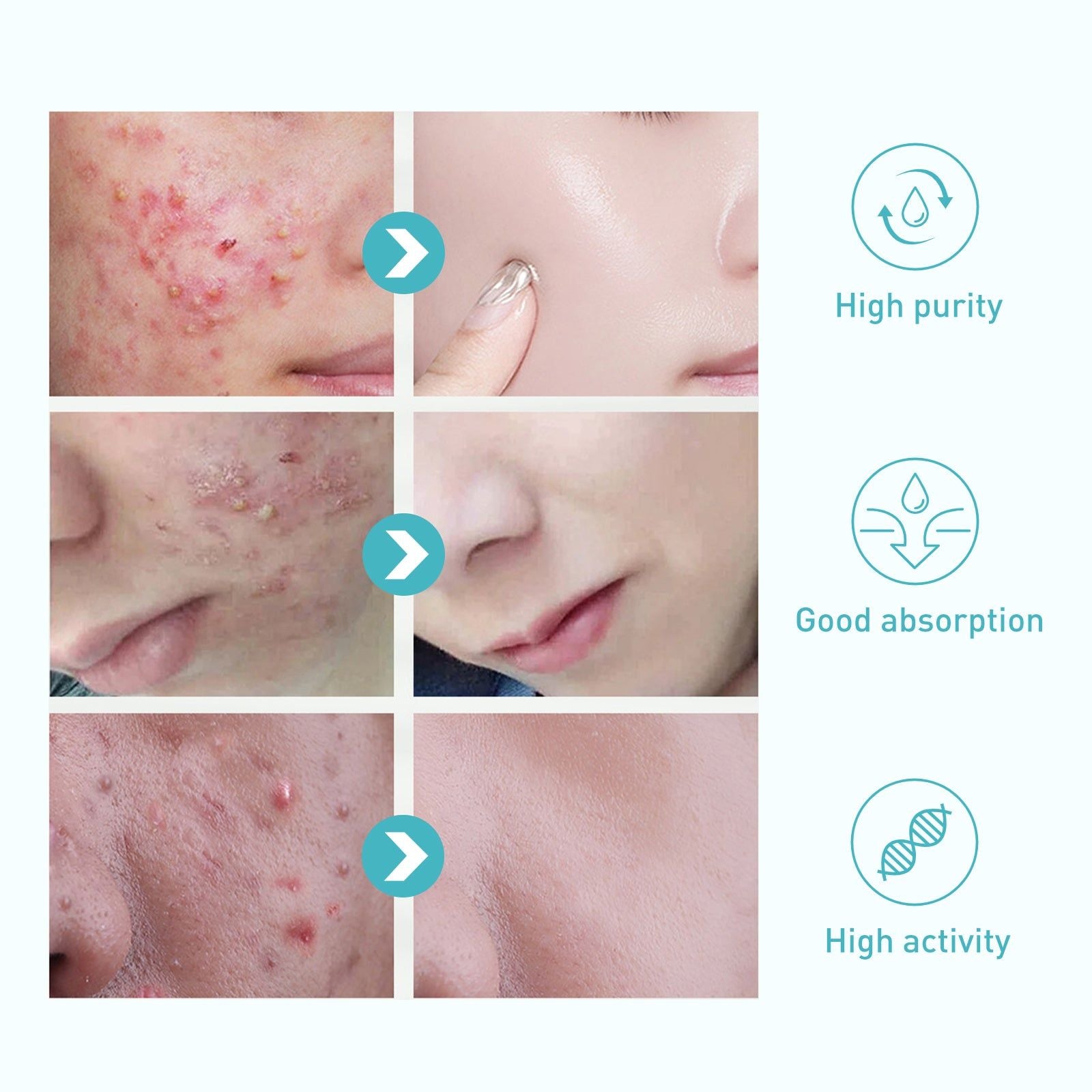Clear Acne Marks Fast, Hydrating Repair Gel for Bright, Smooth Skin ,20g