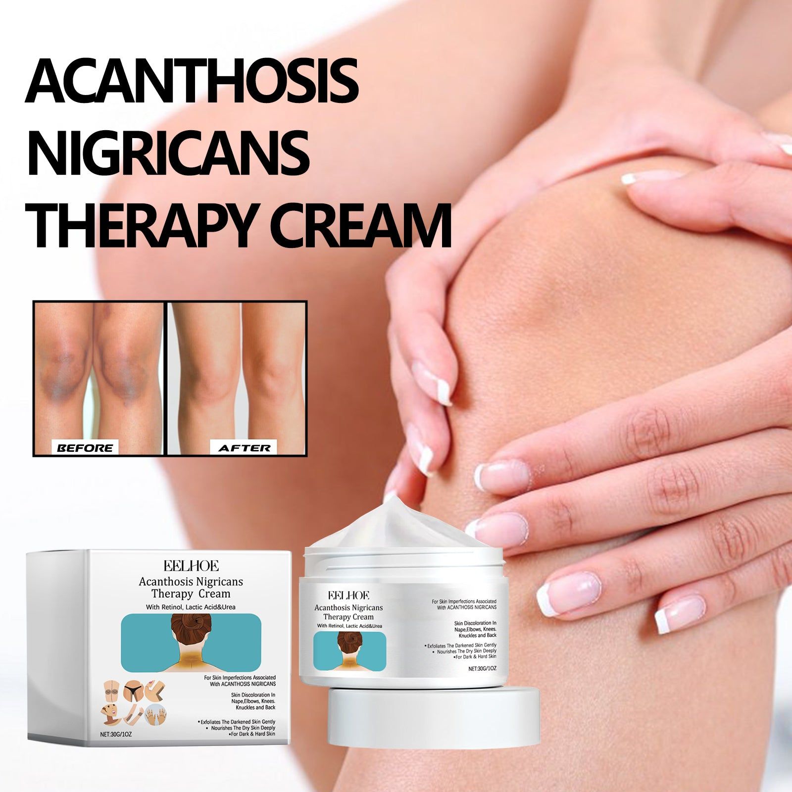 Acanthosis Nigricans Care Cream, Brightening, Moisturizing, Repairing, Skin Tone, Dark Spots ,30g