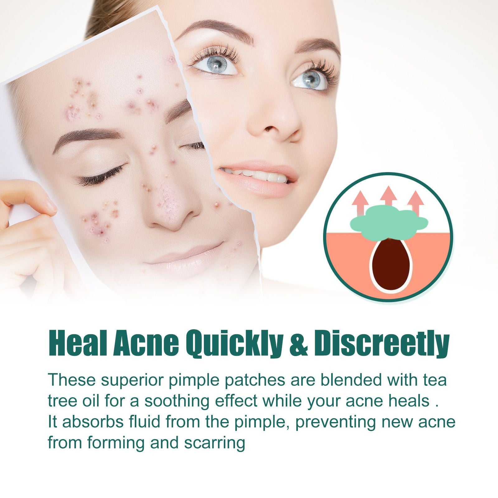 Cartoon Acne Pimple Patches Hydrocolloid Spot Stickers 112pcs