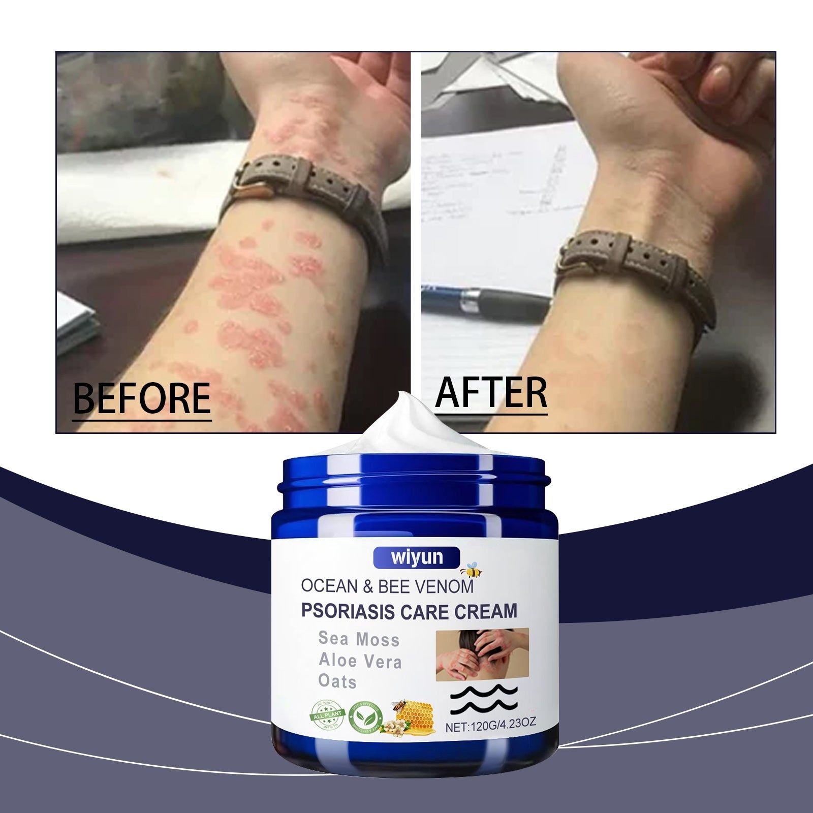 Bee Venom Skin Care Cream for Red Itchy Skin, Moisturizing, Anti-Itchy, Psoriasis Relief ,120g