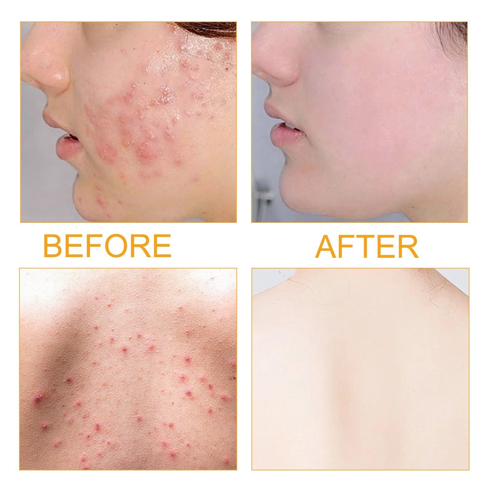 Clear Skin Serum for Acne, Pore Tightening, Oil Control, Brightening, Fast Results ,50ml