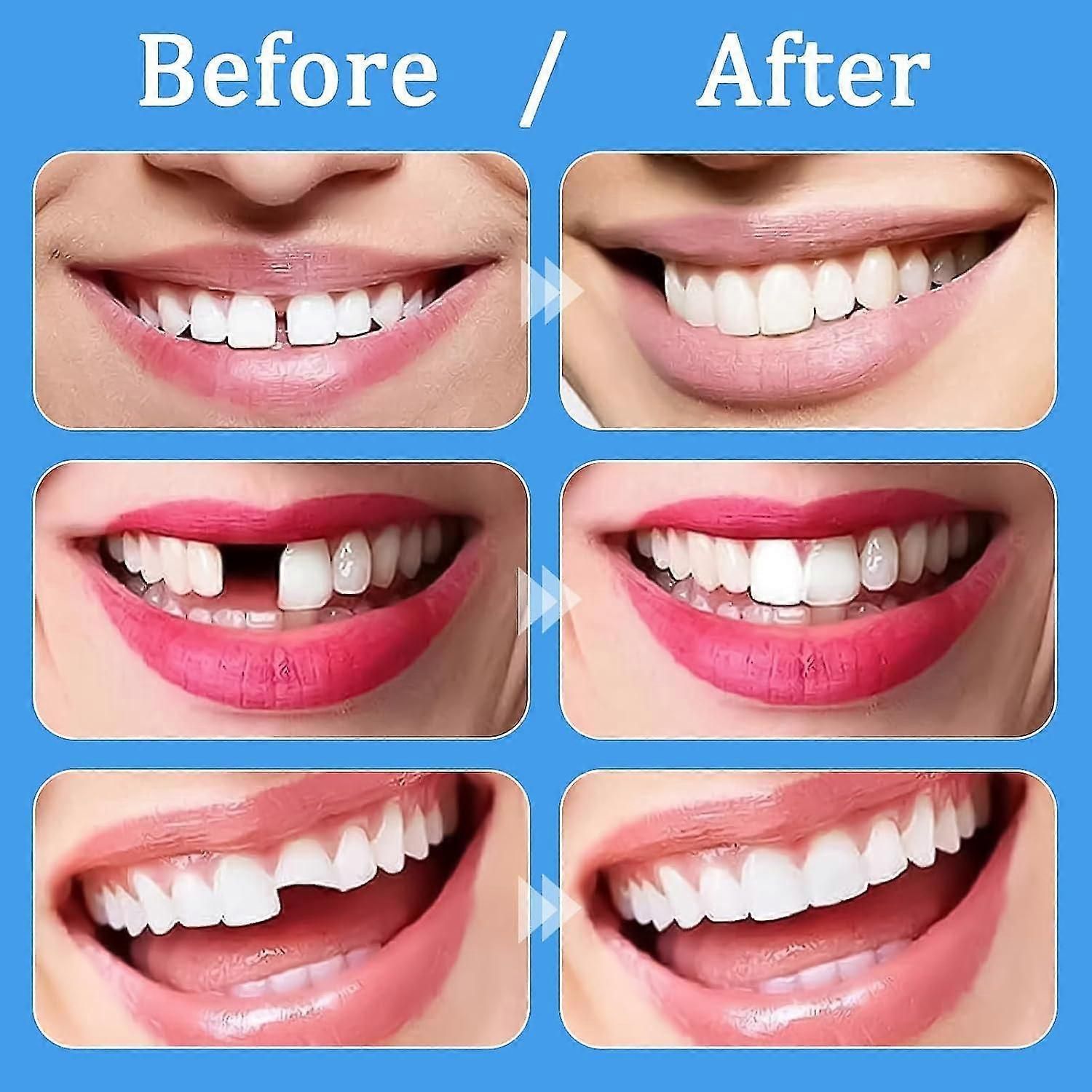 Tooth Filling Repair Kit, Temporary Teeth Filler With 4 Dental Tools, For Temporary Fixing Filling Missing Broken Chipped Tooth zxin
