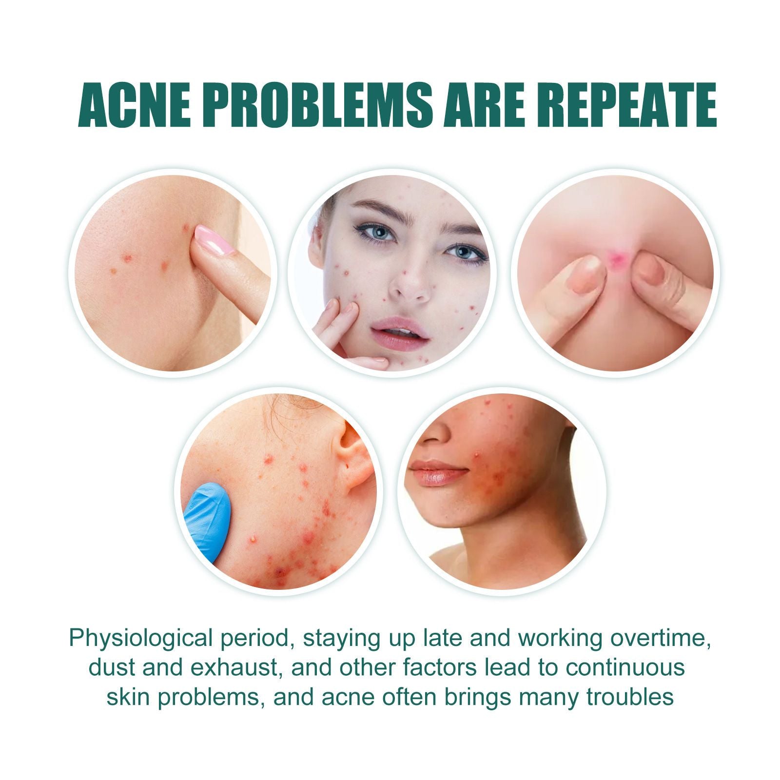 Cartoon Acne Pimple Patches Hydrocolloid Spot Stickers 112pcs