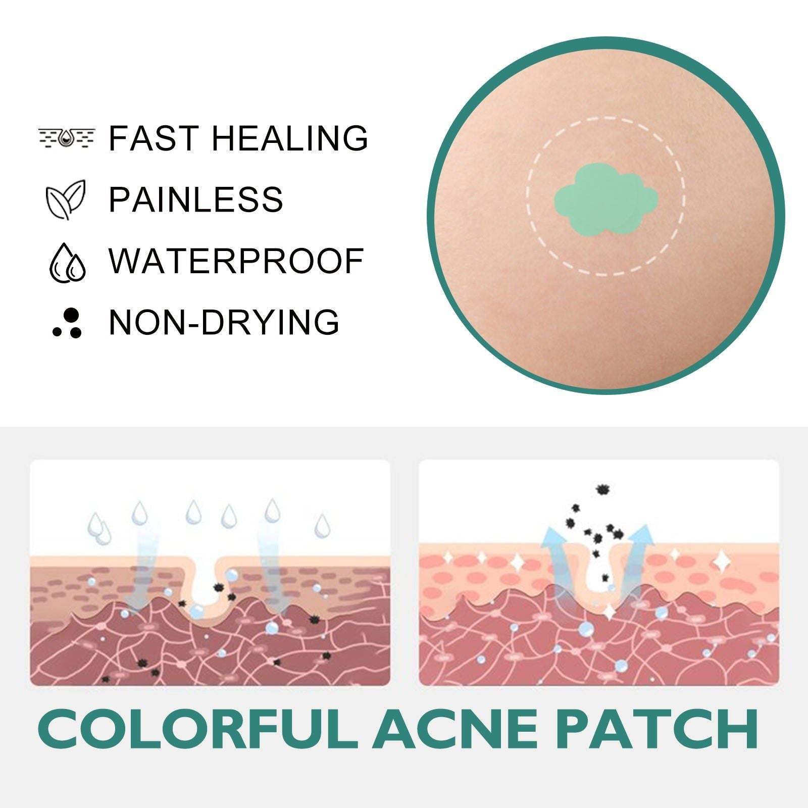 Colorful Acne Patch, Salicylic Acid, Pore Cleanser, Facial Treatment, Clear Skin ,144pieces
