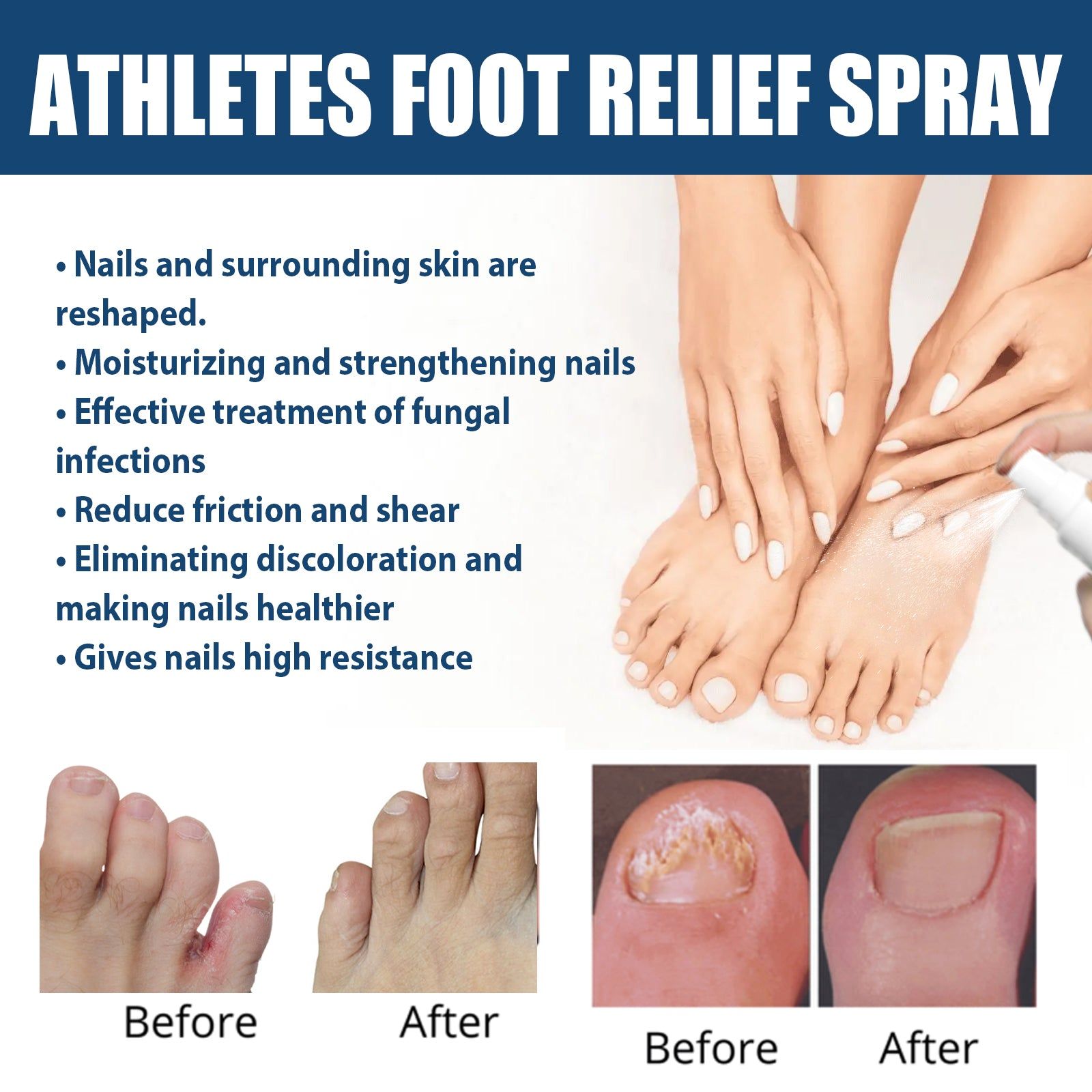 Athletes Foot Relief Spray, Fungal Infection Treatment, Odor & Itch Relief, Moisturizing Foot Care ,30ml