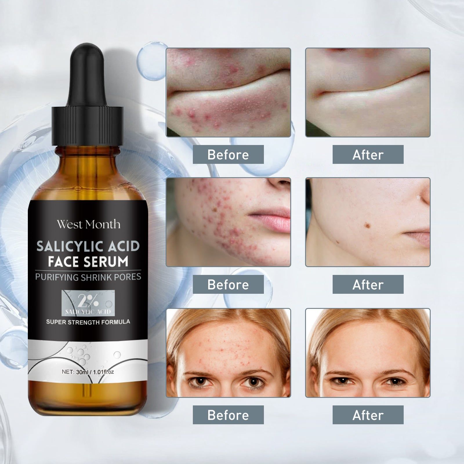 Salicylic Acid Facial Essence for Acne Mark Fade, Clear Skin, Hydrating, Oil Control ,30ml