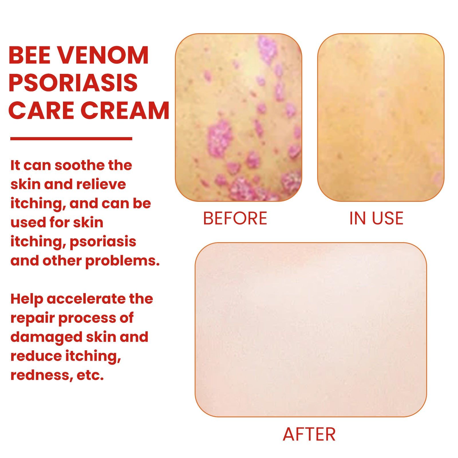 Bee-Poison Cowhide Moss Cream for Skin Care, Relieves Redness, Itchiness, Psoriasis ,20g