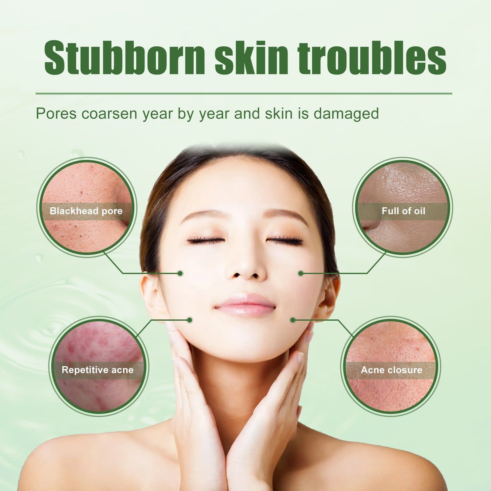 Clear Acne Fast, Deep Clean Skin, Natural Herbal Acne Gel, Oil Control, Pore Shrink ,30ml