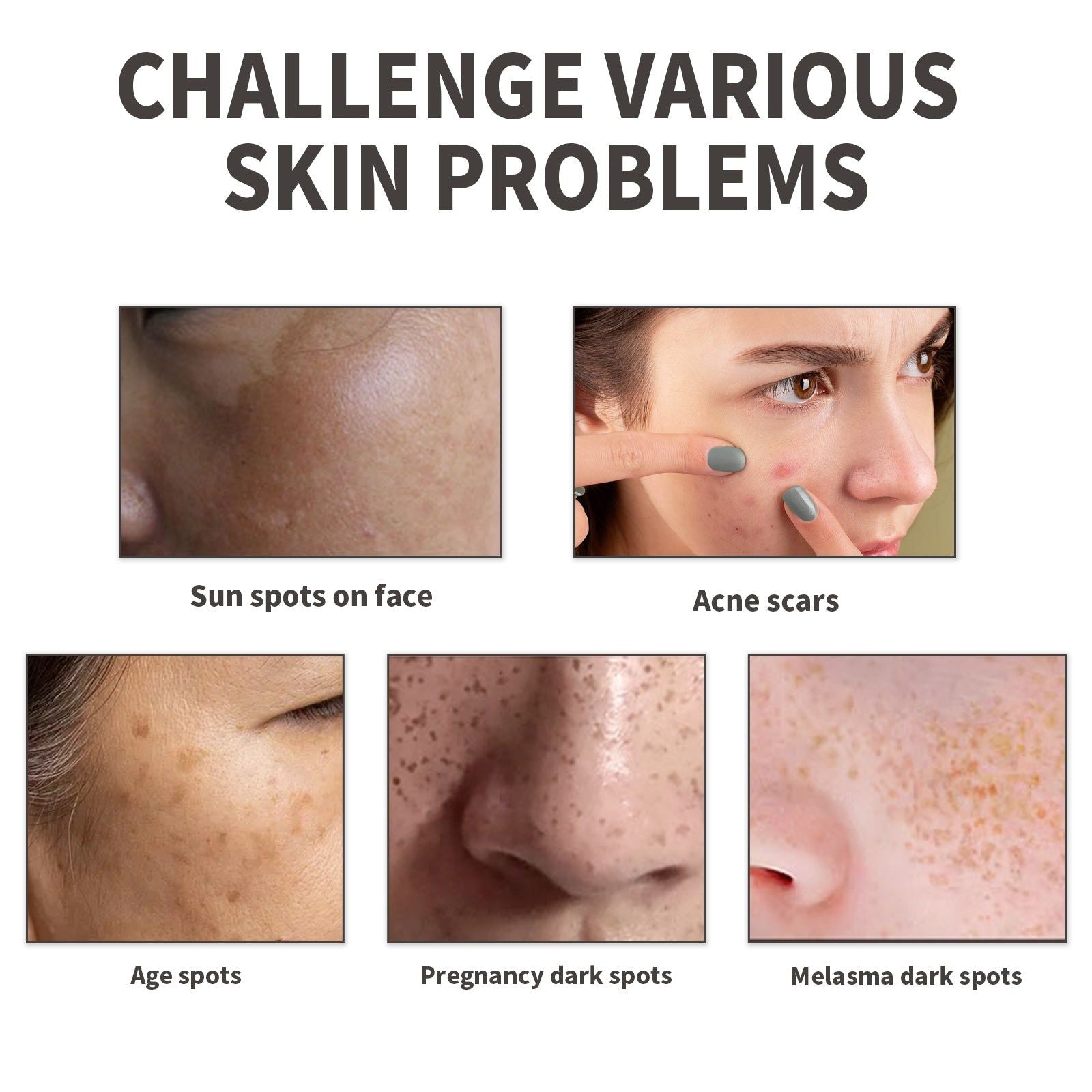 Brighten Skin Serum for Acne, Pimples, and Dark Spots, Hydrating, Anti-Inflammatory ,30ml