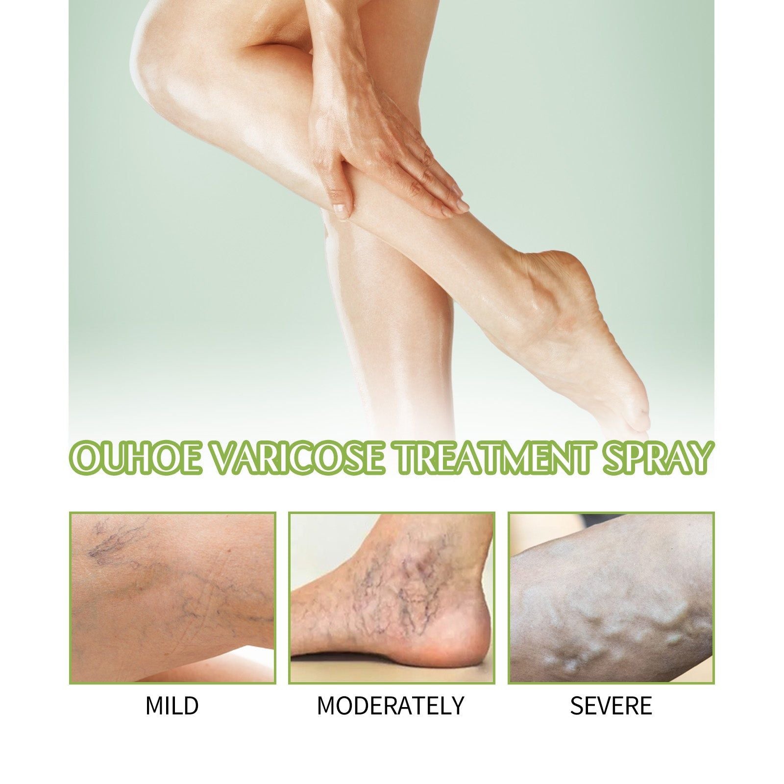 Revitalize Legs with Varicose Spray, Fast Relief for Swelling, Blood Vessel Care ,100ml