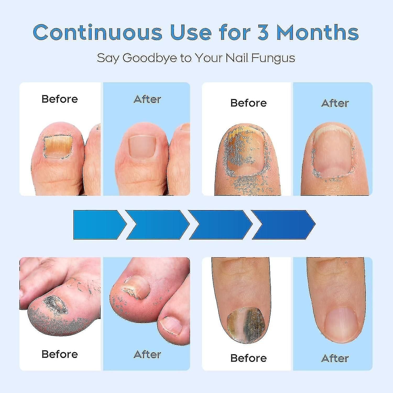 2024 Nail Fungus Laser Treatment Device For Multiple Toenail, Home Use 905nm Infrared Light + 470nm Blue Light Toe Nail Fungus Deviceaa
