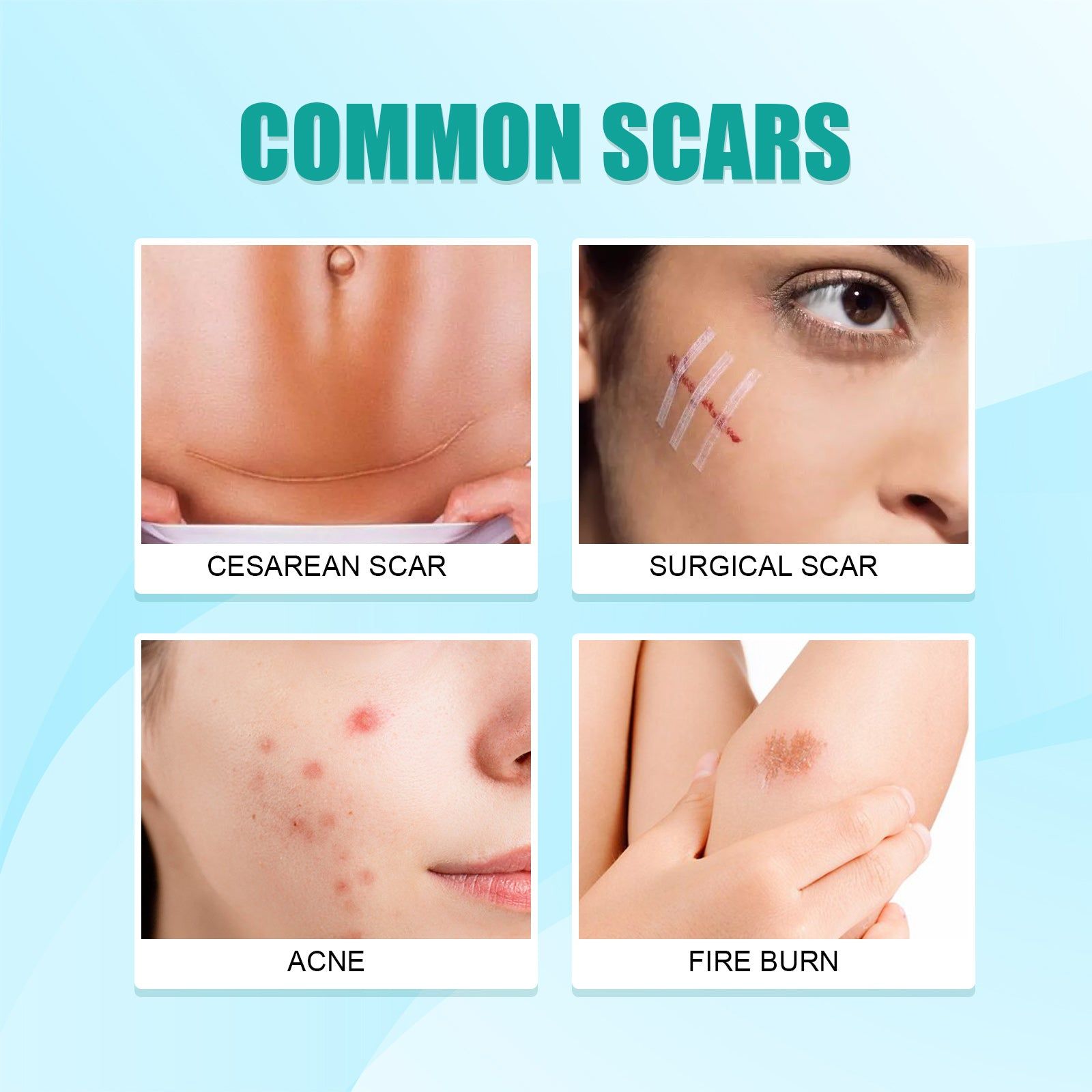Clinically Proven Scar Care Gel, Fade Scars, Reduce Scar Formation, Smooth Skin ,15g
