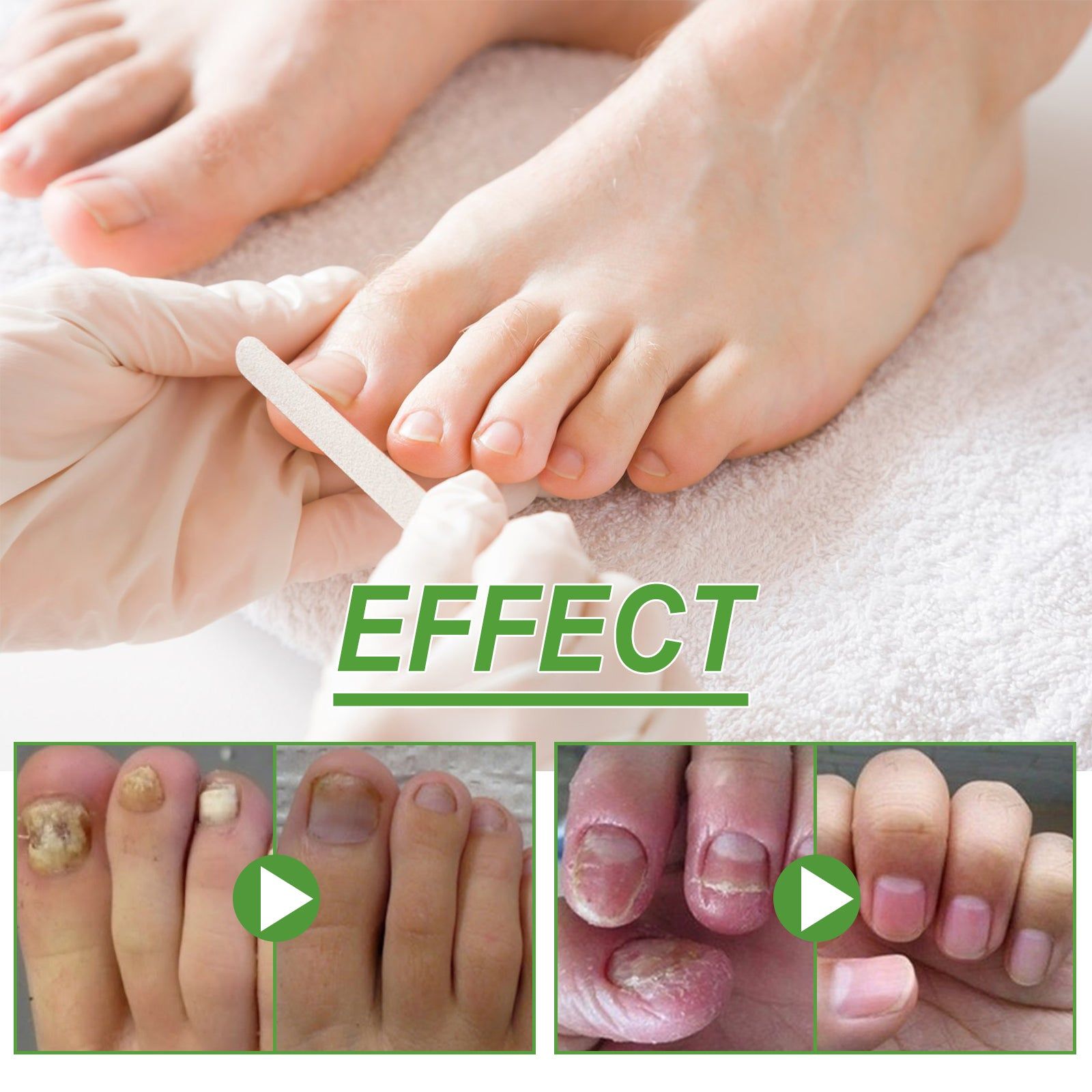 5-Day Nail Repair Roller, Nourishing, Strengthening, Fungal Treatment ,10ml/box