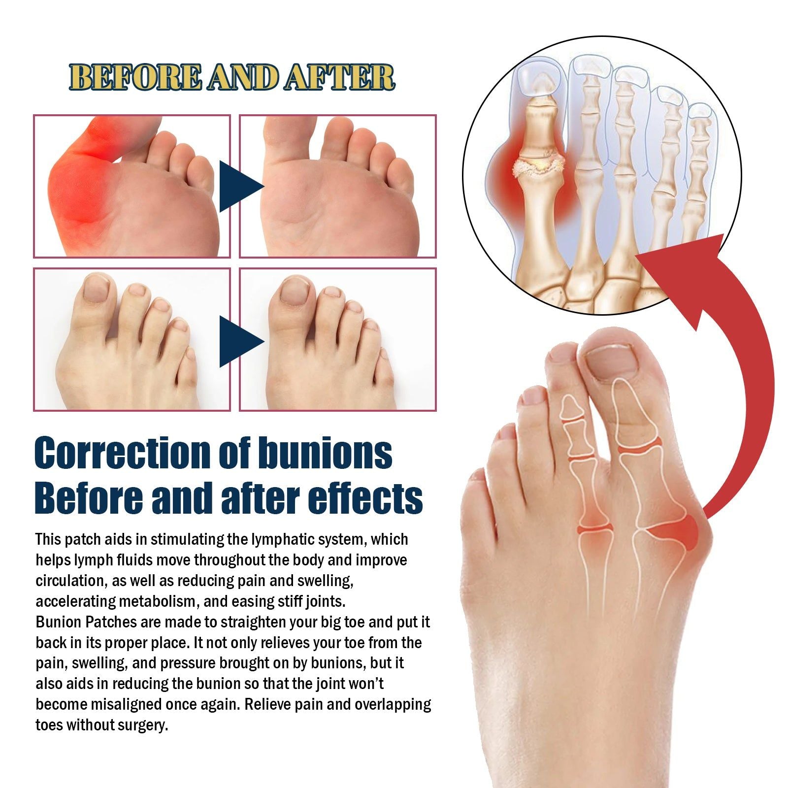 Bunion Patch Relieve Pain Swollen Thumbs, Foot Joint Relief, Natural Healing ,5pcs
