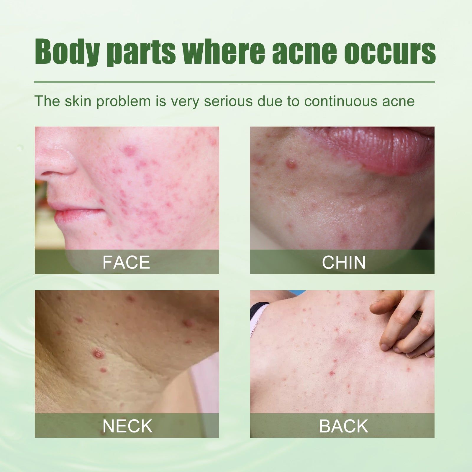 Clear Acne Fast, Deep Clean Skin, Natural Herbal Acne Gel, Oil Control, Pore Shrink ,30ml