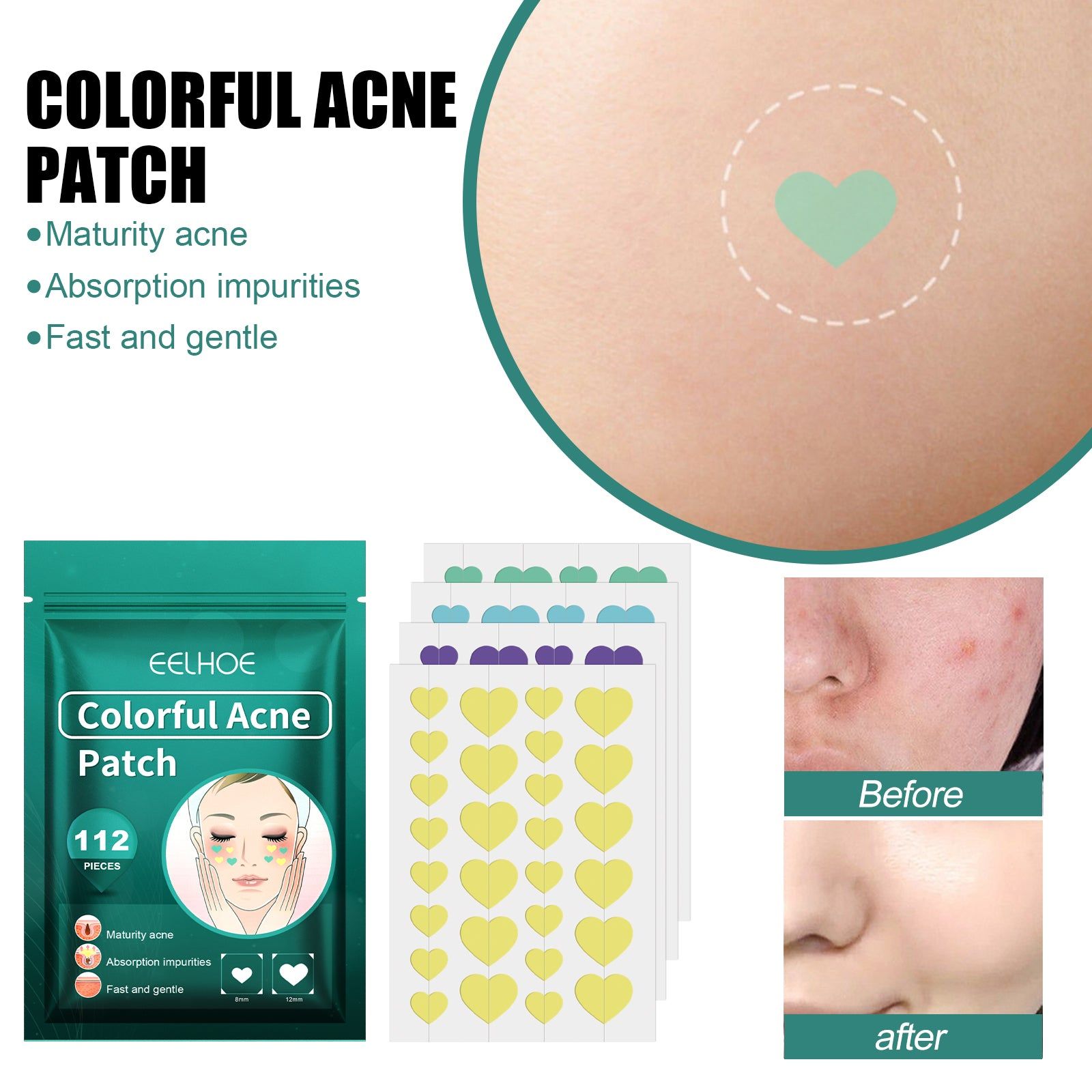 Colorful Acne Patch, Clear Acne Removal, Fast Spot & Mark Healing ,144pieces