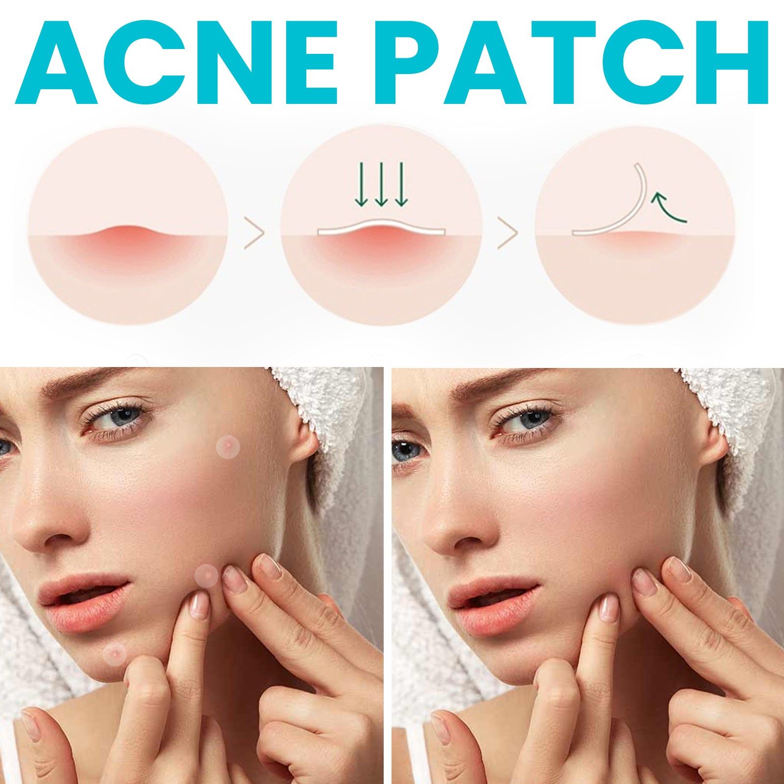 Acne Patch, Reduce Acne Fast, Invisible Hydrocolloid Pimple Cover, Clear Skin ,72pcs