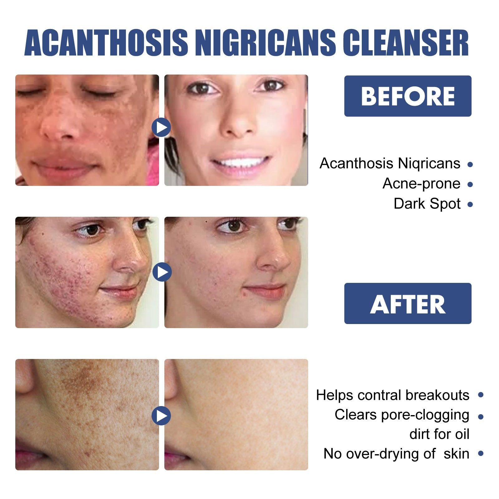 Black Acanthoderm Face Cleanser, Brighten Dark Spots, Oil Control, Moisturizing ,50ml