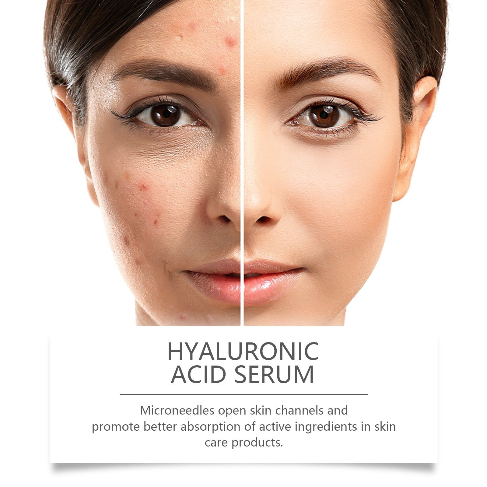 Hydrating Hyaluronic Acid Serum with Microneedle Roller for Water Replenishment and Glowing Skin ,10ml/box