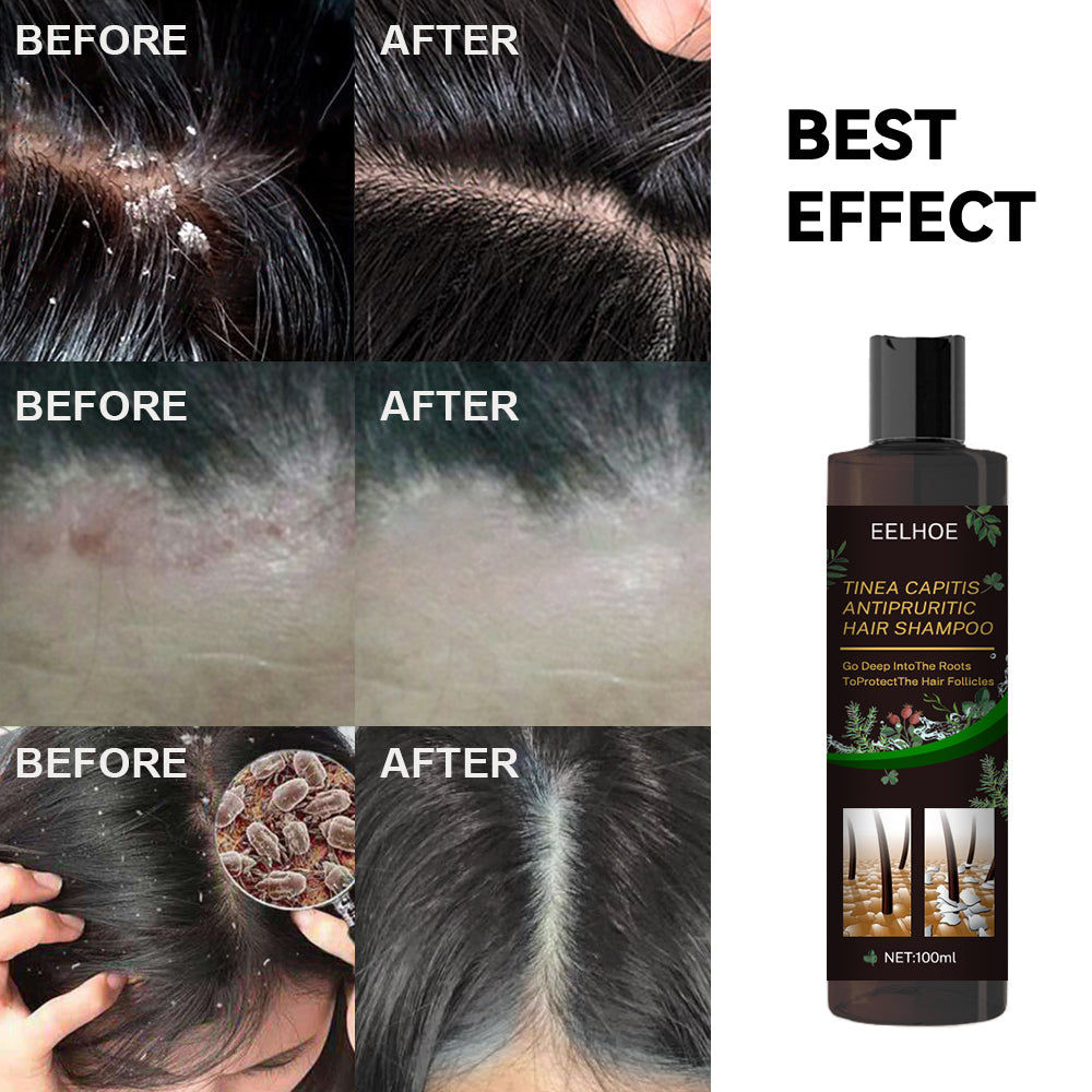 Anti-Dandruff Itch Relief Shampoo for Scalp, Deep Nourishing Hair Care, Natural Ingredients ,100ml