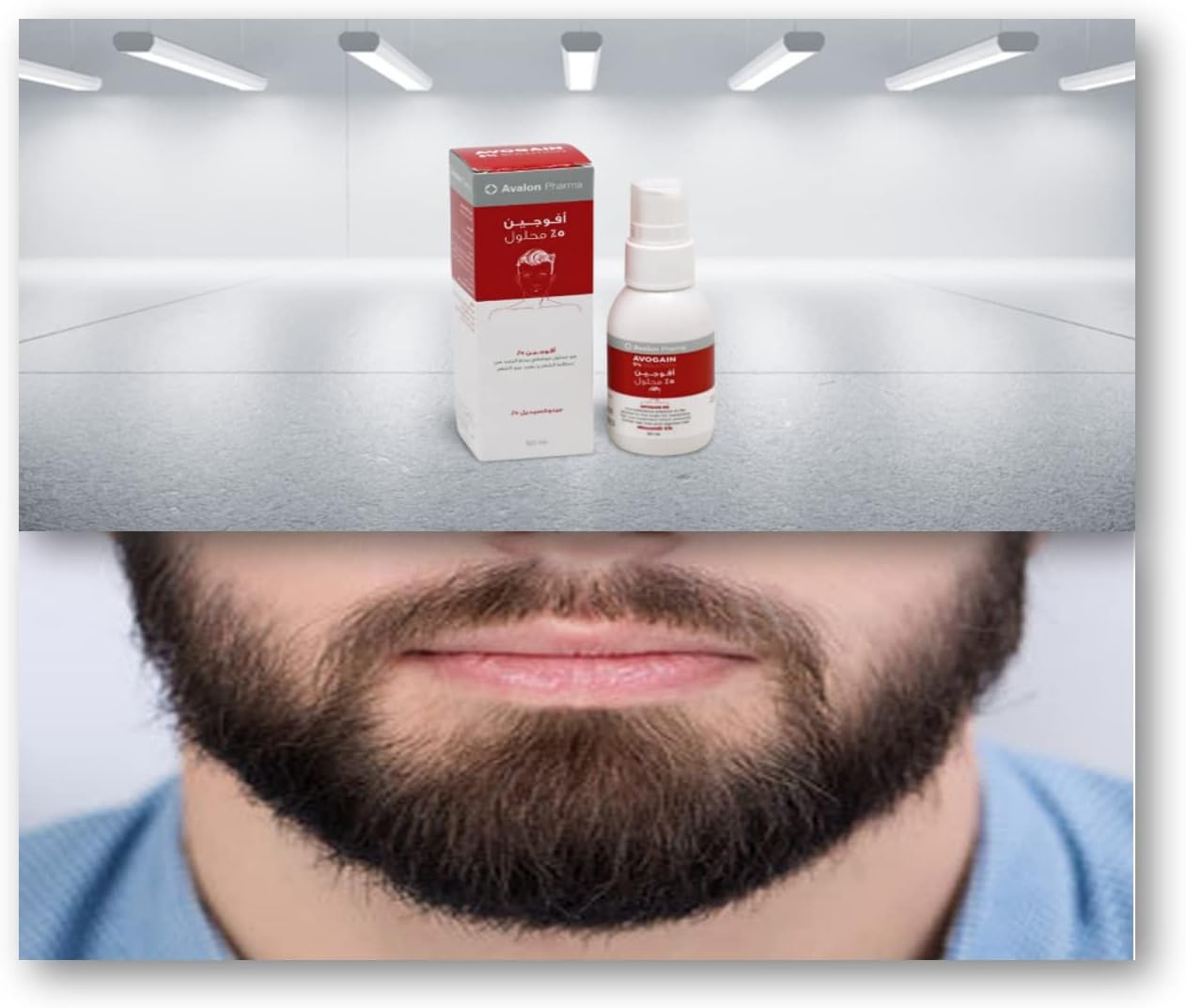 Avogain 5% Minoxidil Solution, Prevents Hair Loss and Improves Hair growth, 1 Months Supply
