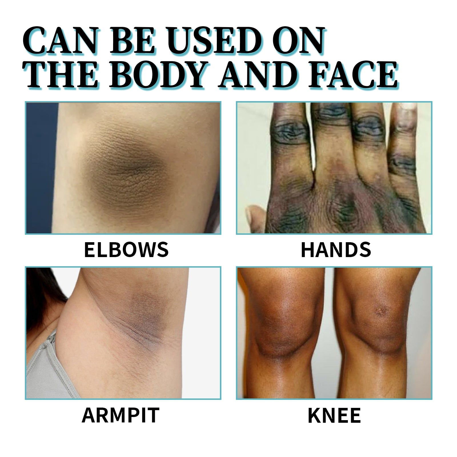 Acanthosis Nigricans Cream, Fade Joint Black Spots, Brighten Skin, Moisturize, Repair ,30ml