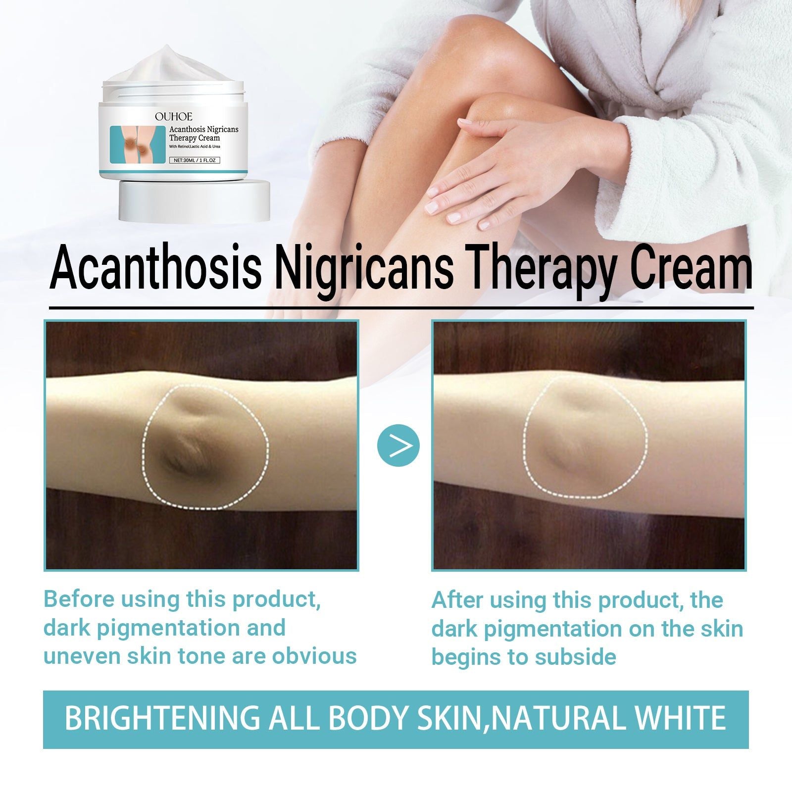 Acanthosis Nigricans Cream, Fade Joint Black Spots, Brighten Skin, Moisturize, Repair ,30ml