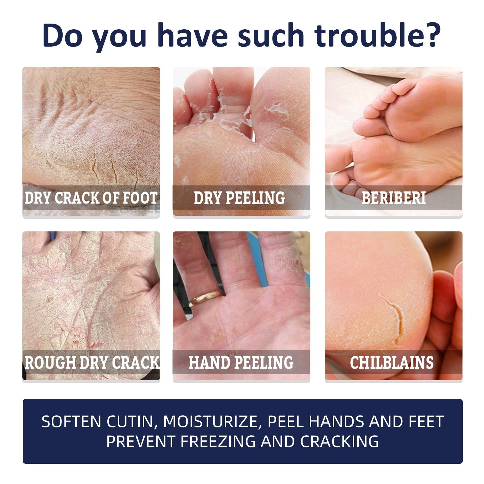 Anti-Crack Hand & Foot Cream, Deep Moisturizer, Softens Skin, Prevents Dryness ,30g