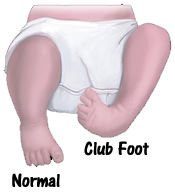 Dennis Brown Splint (DB Splint) – Orthosis for Clubfoot Correction