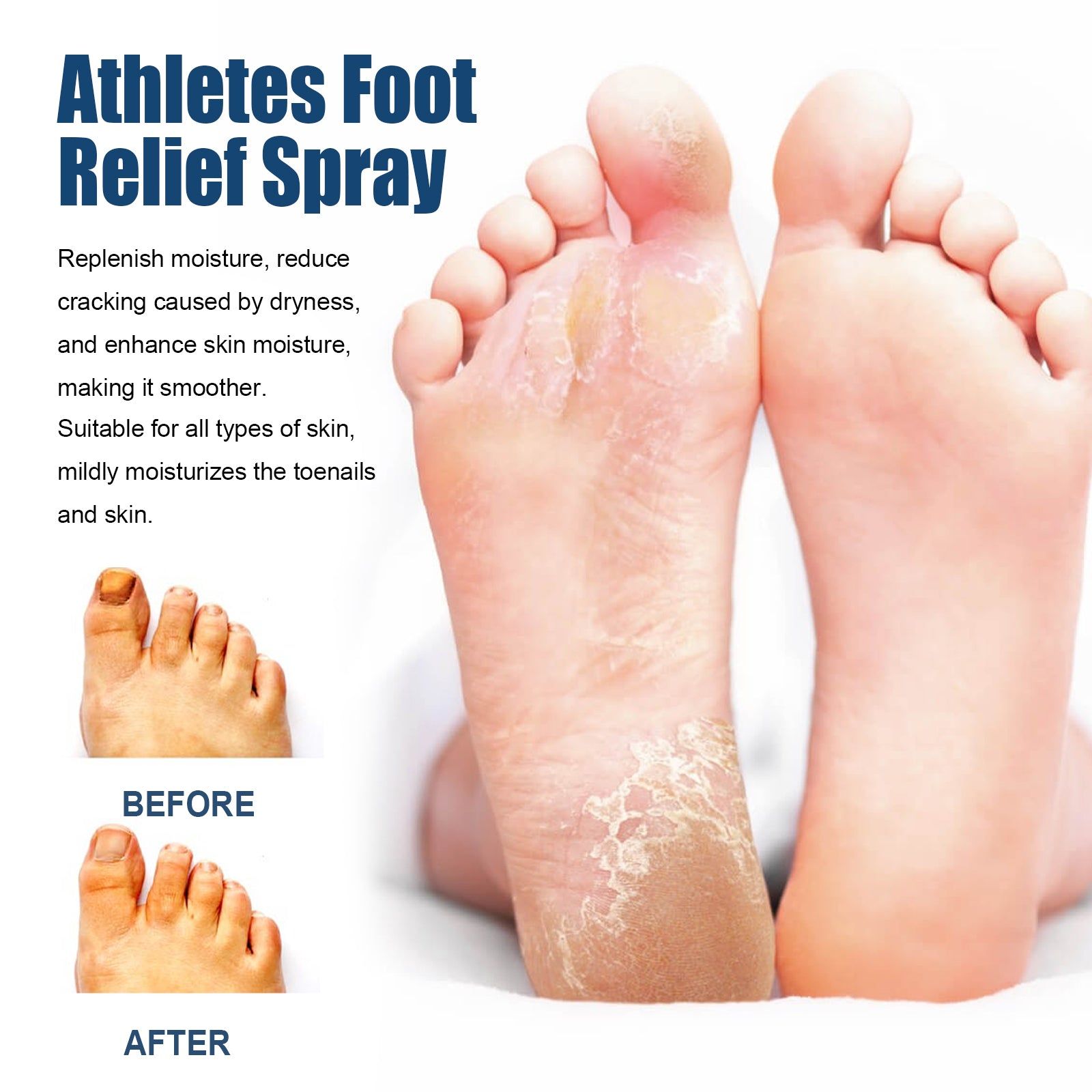 Athletes Foot Relief Spray, Fungal Infection Treatment, Odor & Itch Relief, Moisturizing Foot Care ,30ml