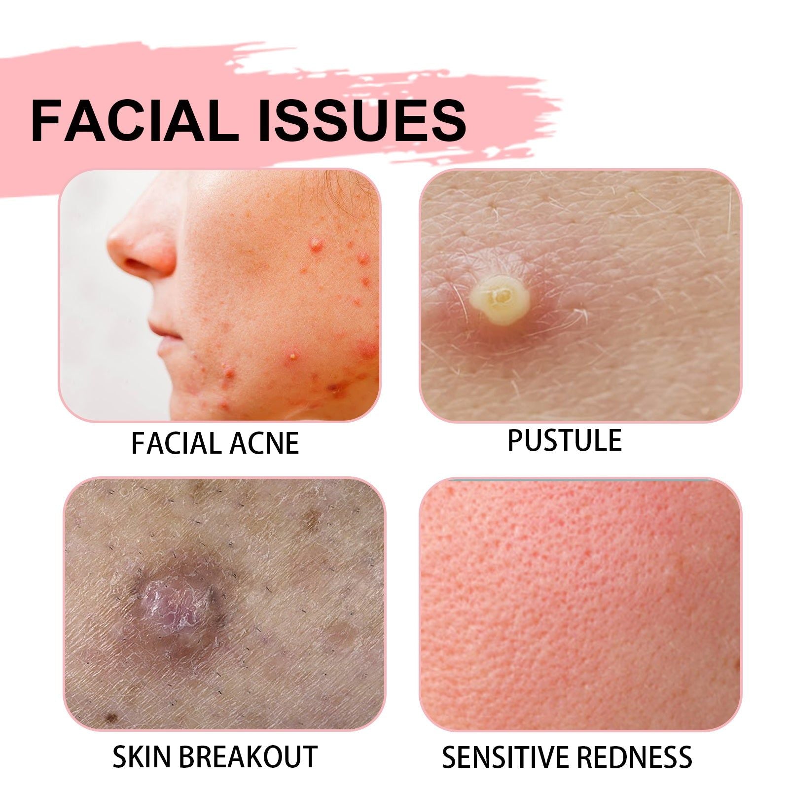 Acne Spot Treatment, Reduce Acne Fast, Clear Skin, Pore Refining, Brightening ,30ml