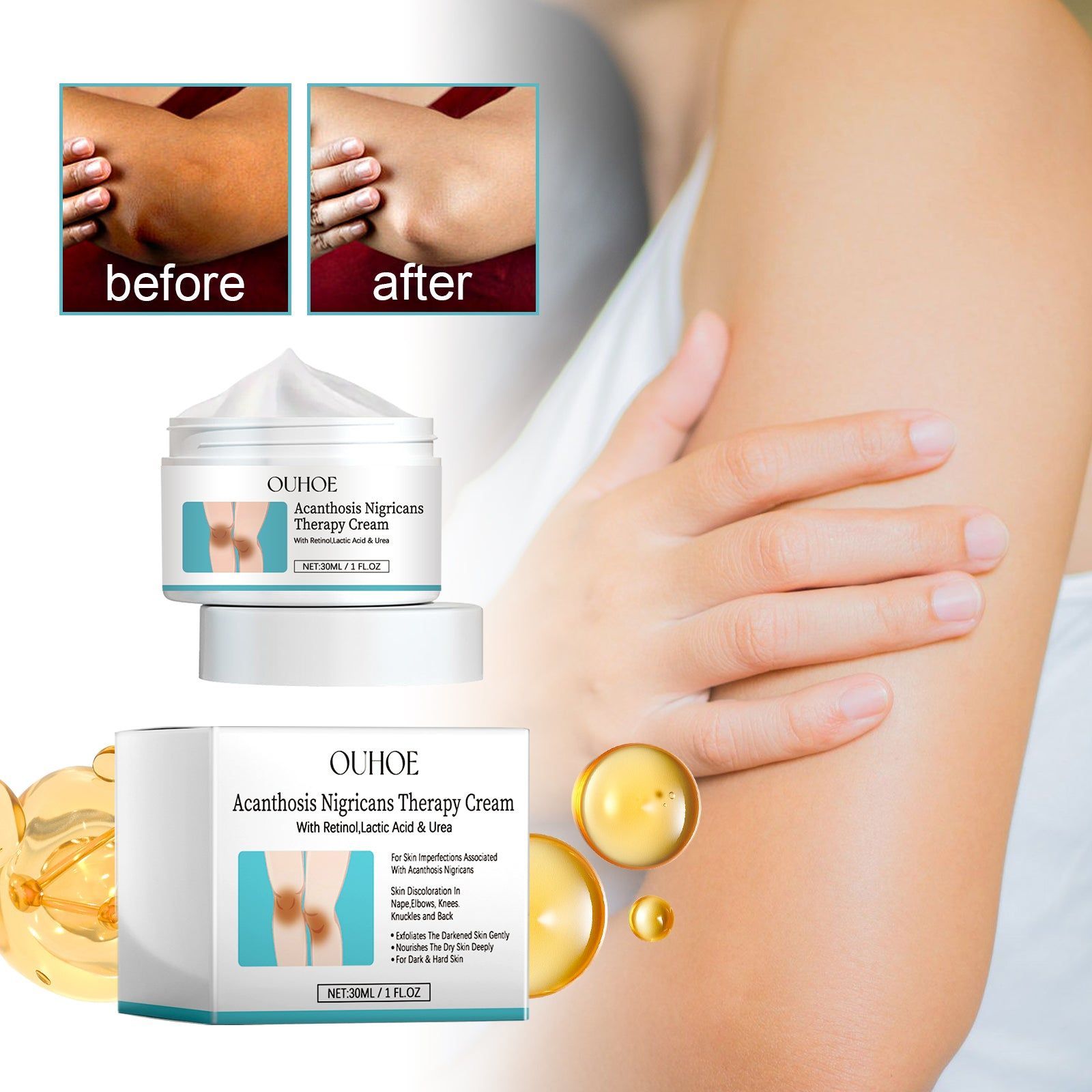 Acanthosis Nigricans Cream, Fade Joint Black Spots, Brighten Skin, Moisturize, Repair ,30ml