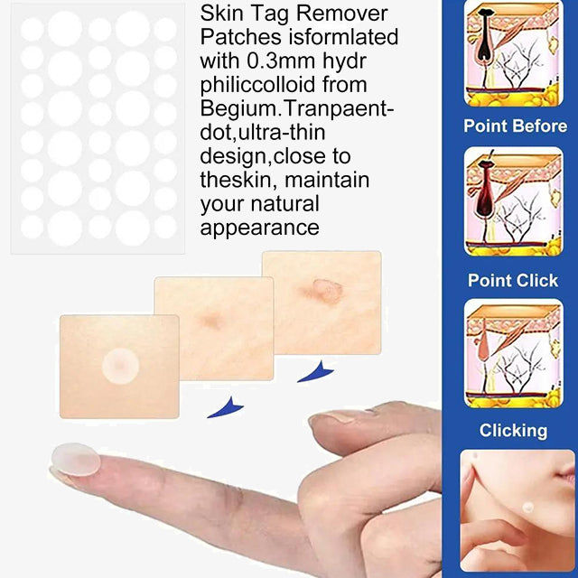 Auto Skin Tags Removal Tool Device with Cleansing Wipes - Safe, Painless Skin Tag Remover Kit