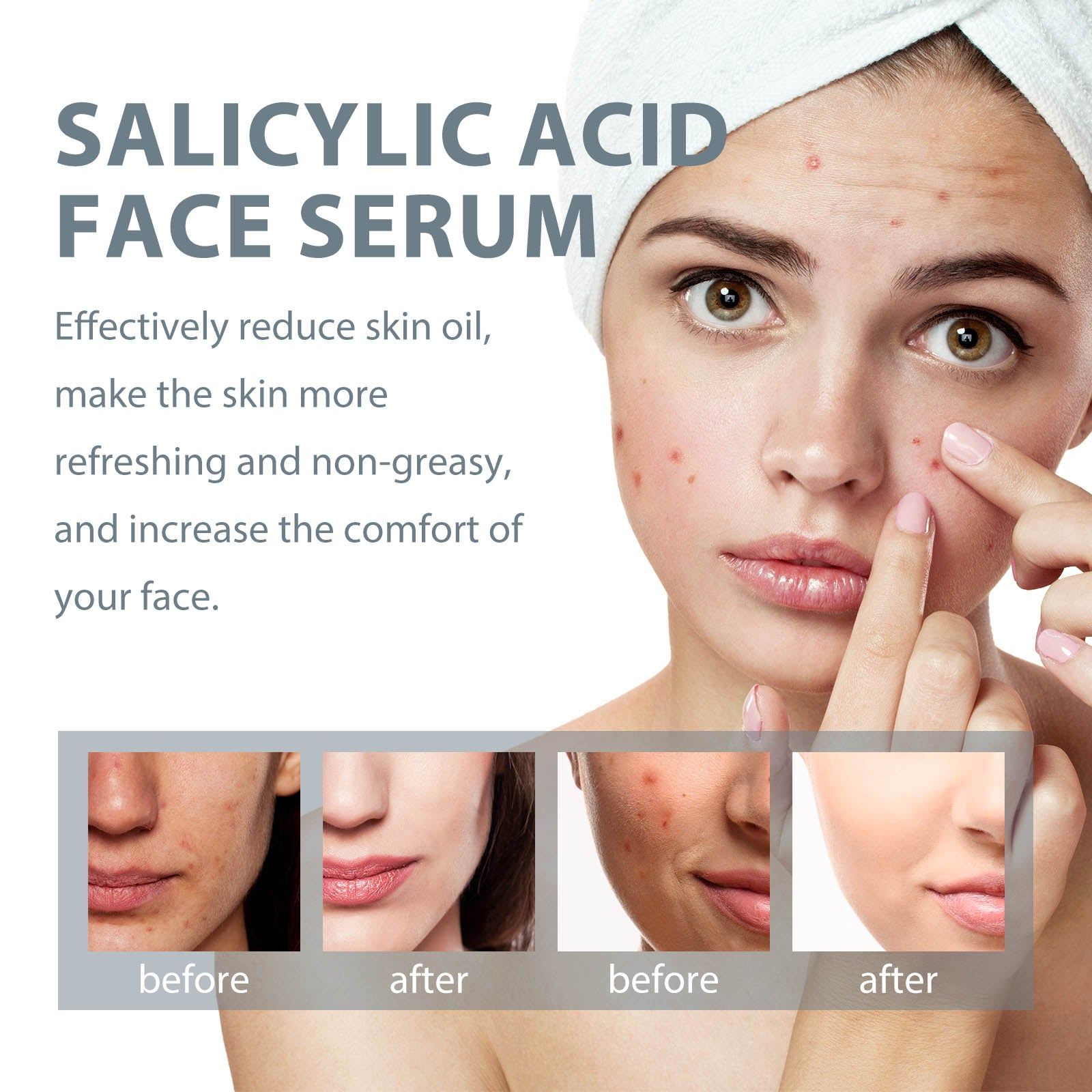Salicylic Acid Facial Essence for Acne Mark Fade, Clear Skin, Hydrating, Oil Control ,30ml
