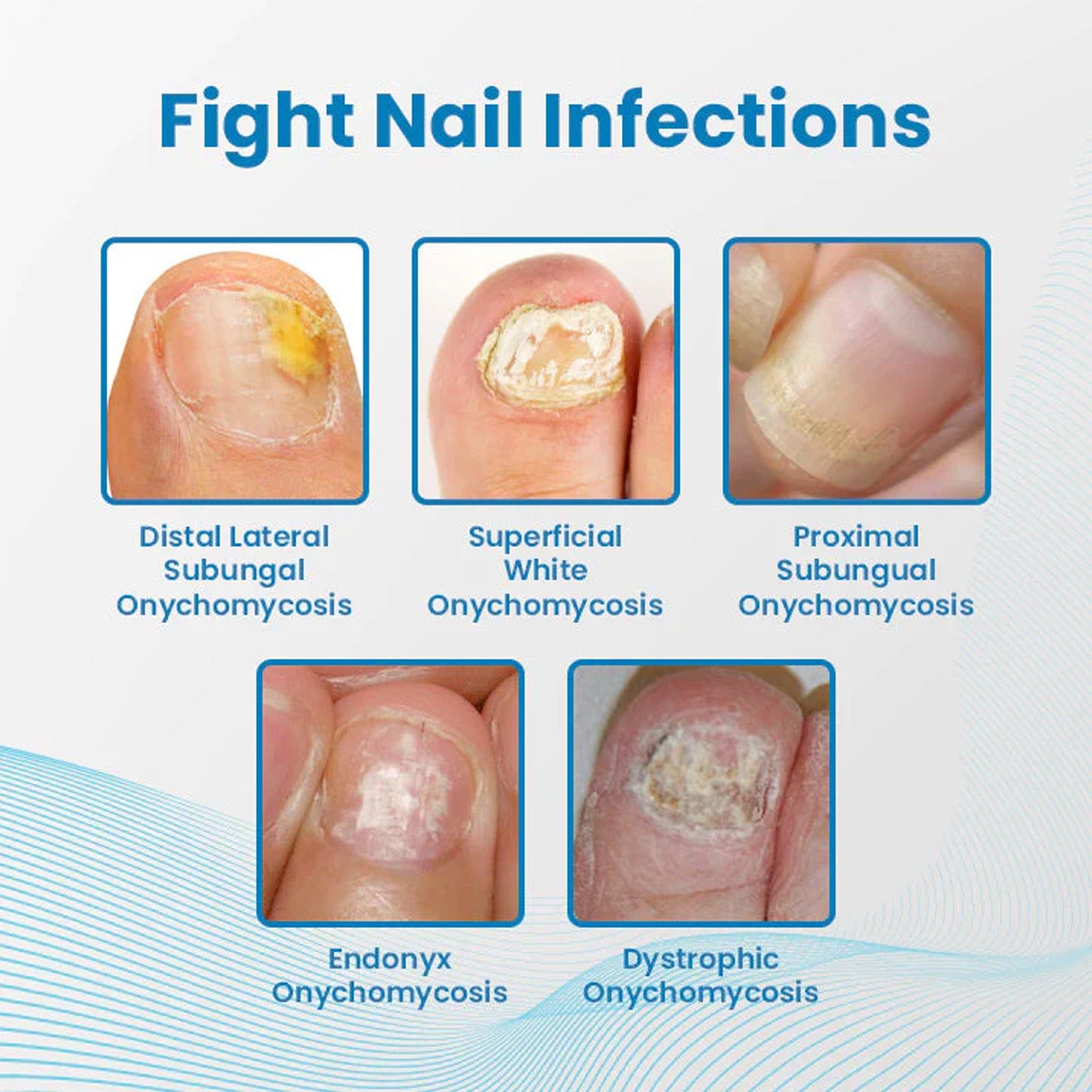 Anti-Paronychia Nail Repair Gel, Fast Pain Relief, Fungal & Bacterial Care, Nail Strengthening, Healthy Nail Care ,3ml