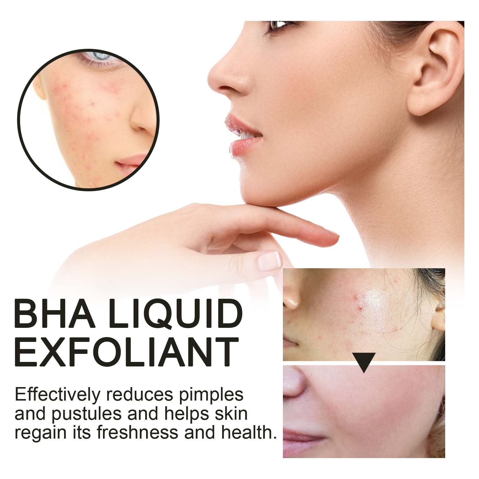 Salicylic Acid Acne Serum, BHA Liquid Exfoliant, Pore Tightening, Clear Skin, Moisturizing ,118ml