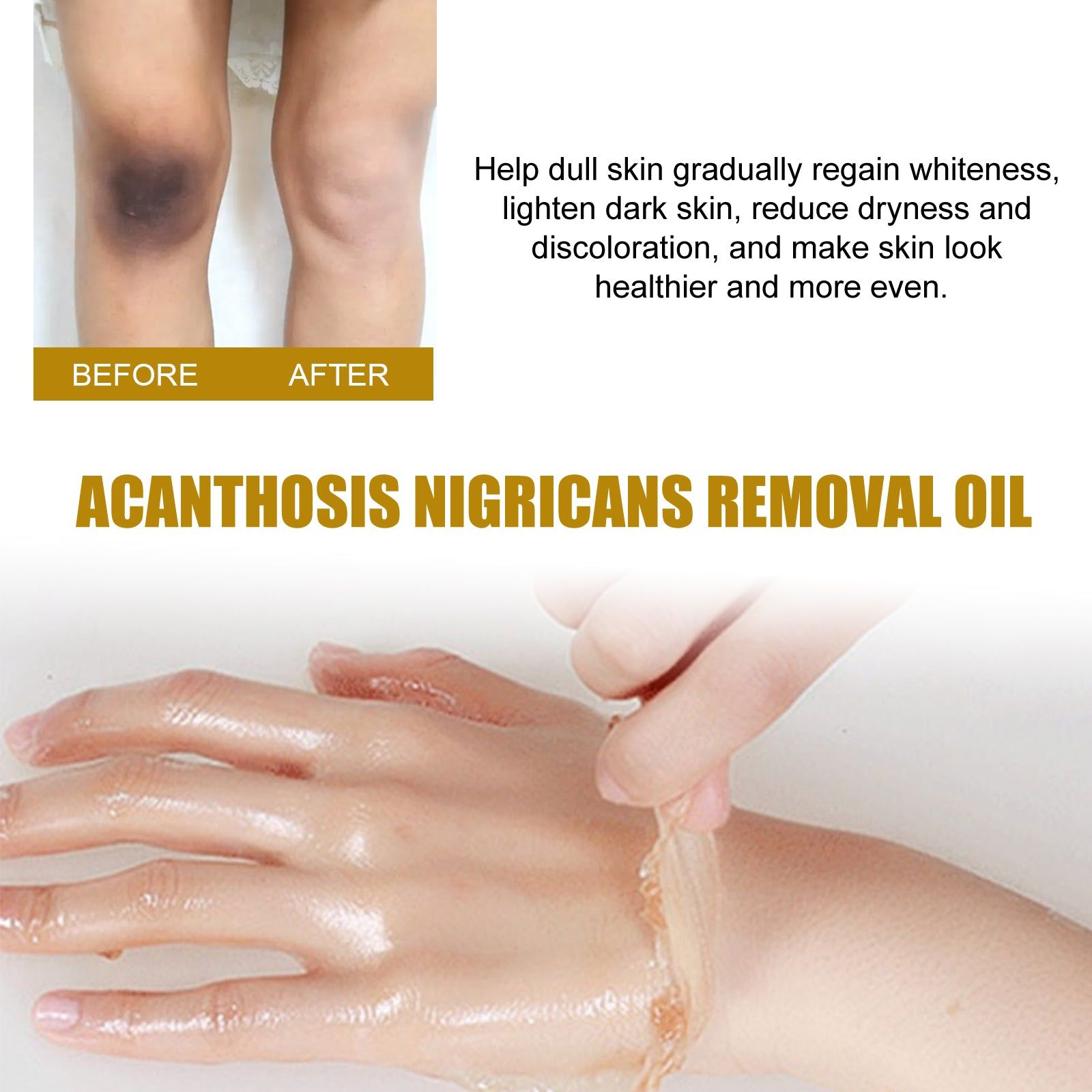 Acanthosis Nigricans Removal Oil, Brightening Skin, Dark Spot Corrector, Natural Exfoliating, Skin Lightening, Melanin Reducer ,50ml