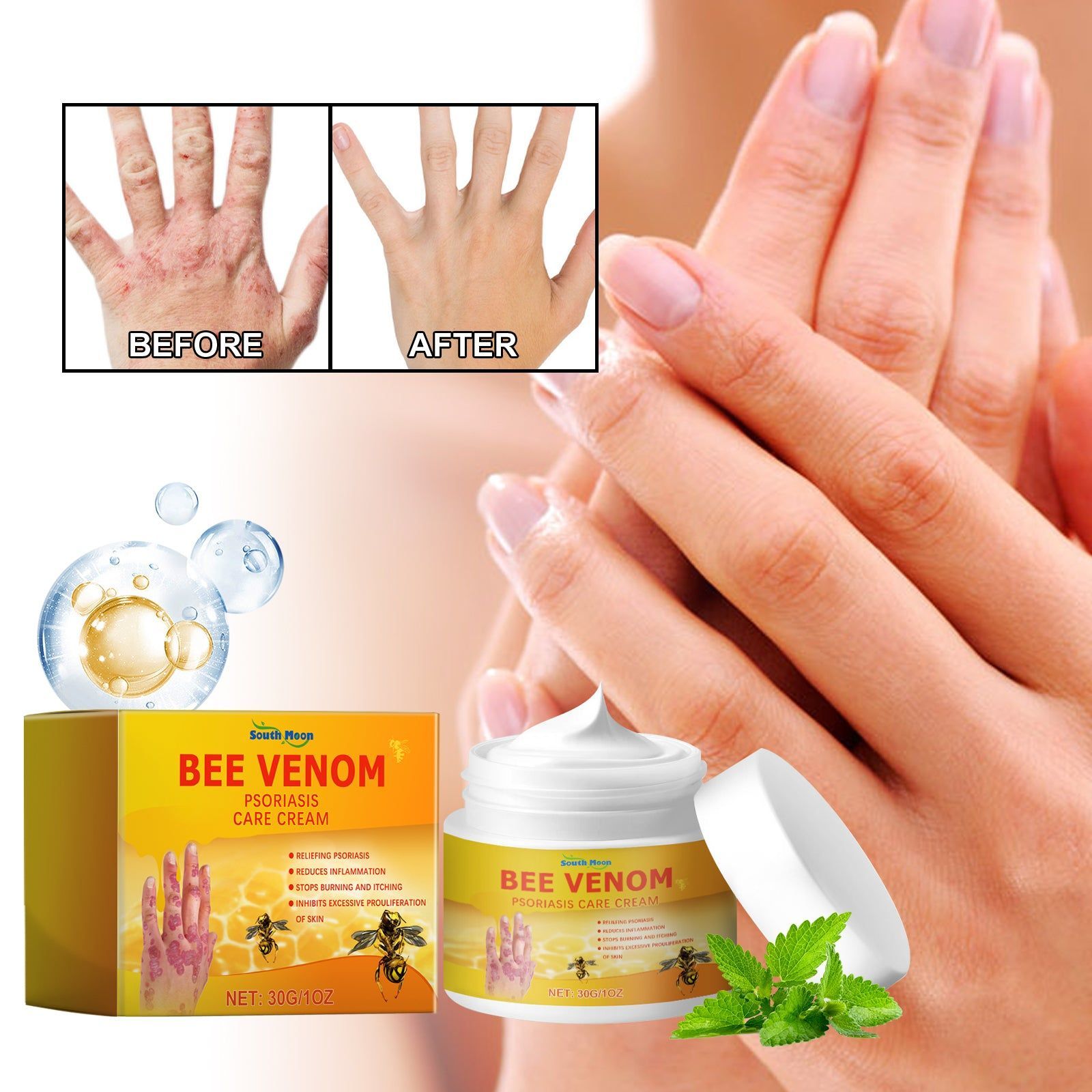 Bee Venom Psoriasis Cream, Skin Repair, Soothing Moisturizer for Redness and Discomfort ,30g