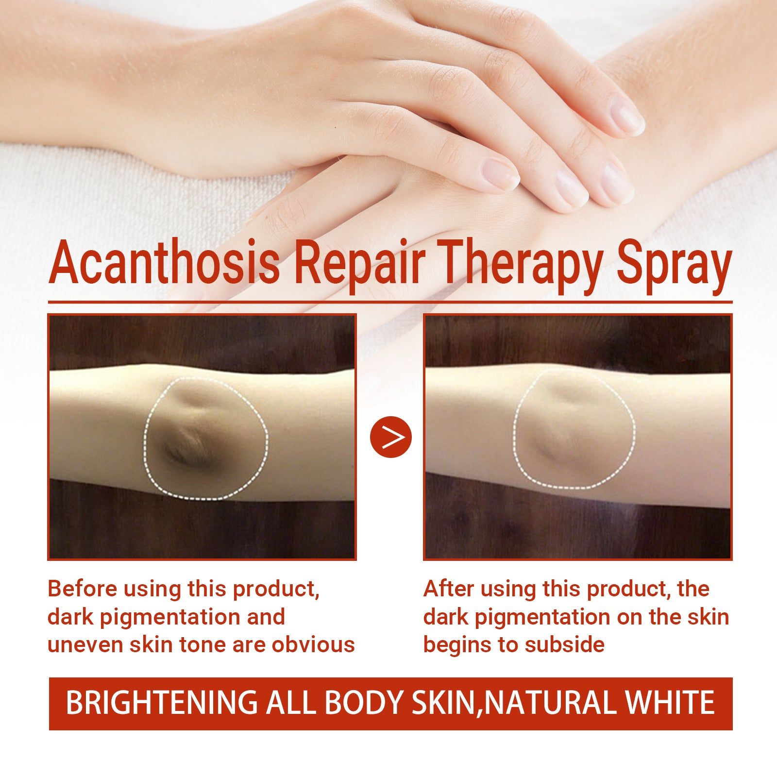 Black Acanthoderma Treatment Spray for Even Skin Tone, Skin Care, Melanin Repair ,30ml